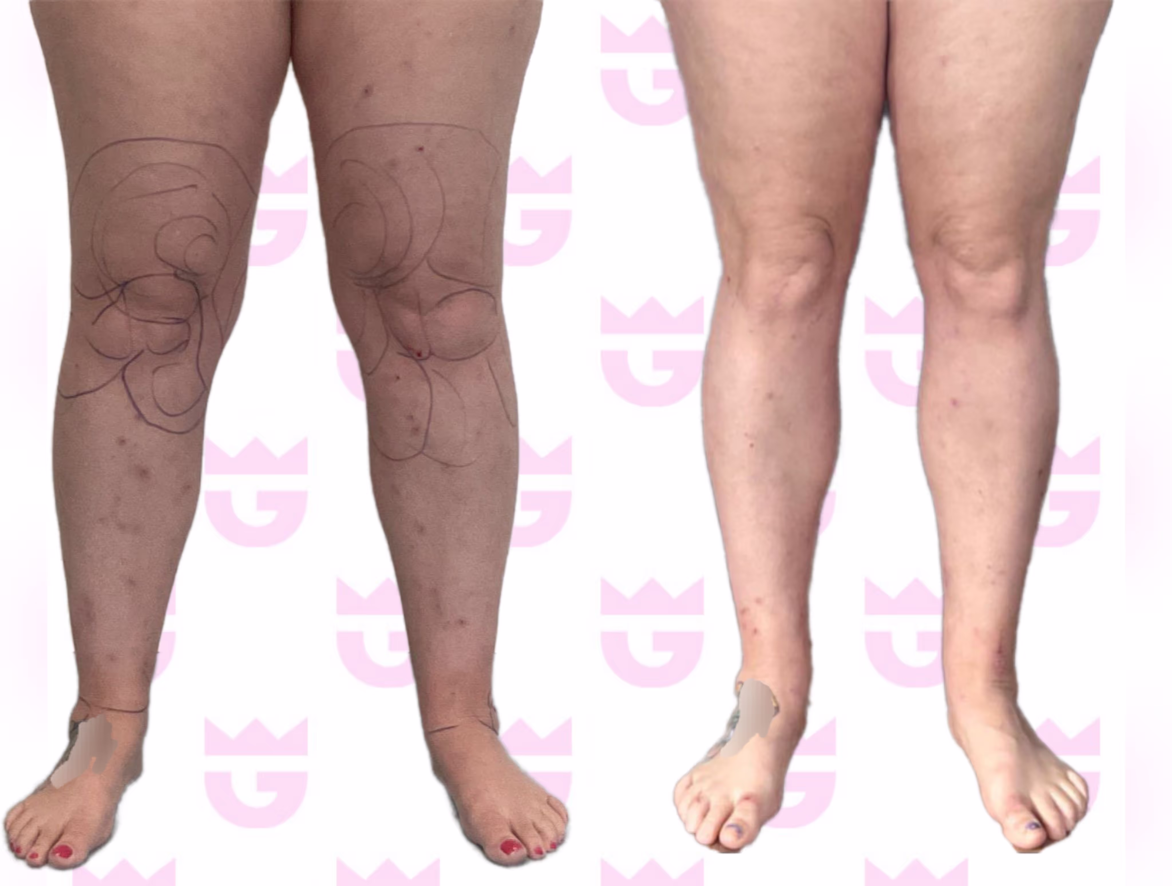 Calf Liposuction Gallery