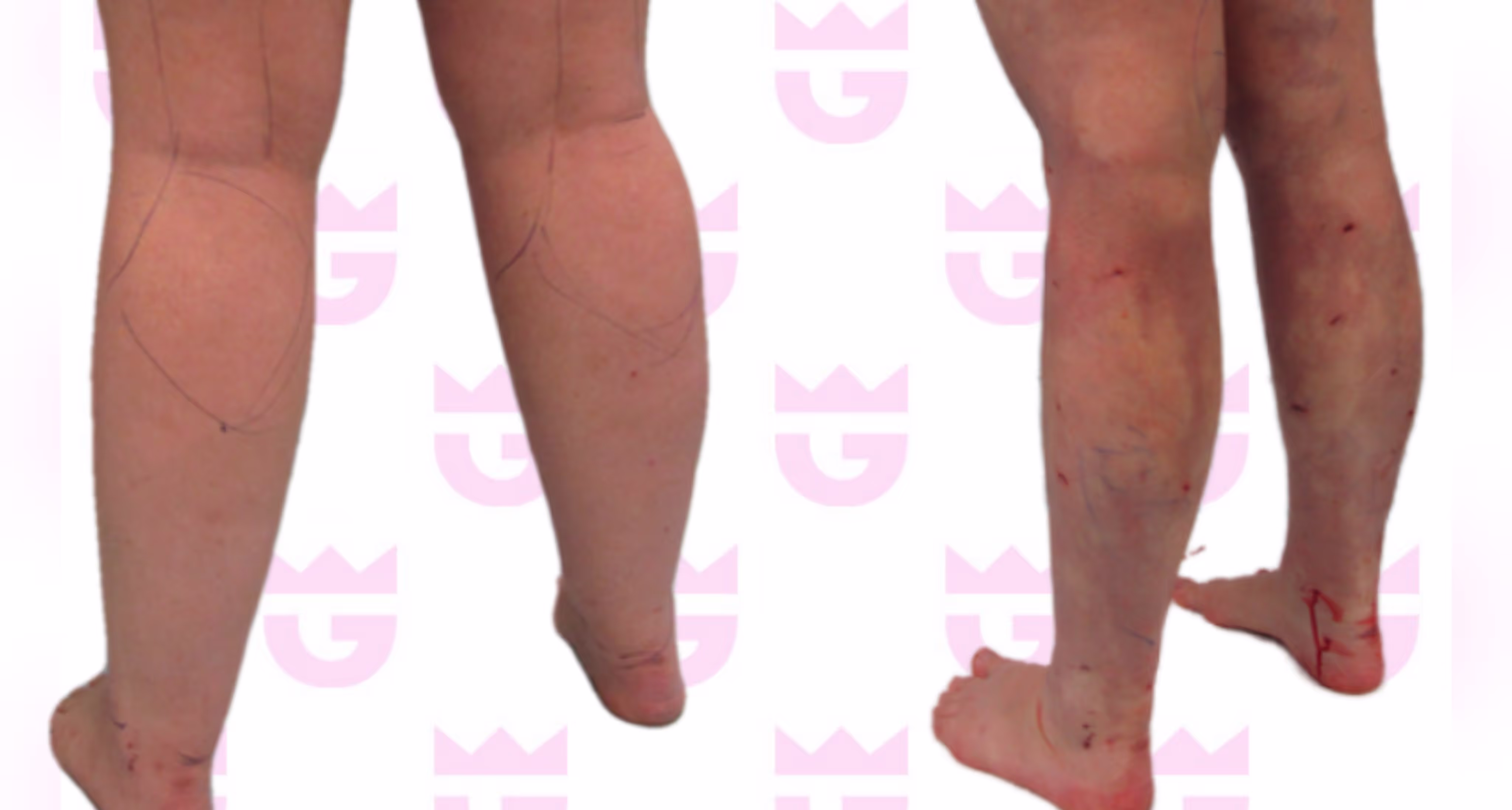 Calf Liposuction Gallery