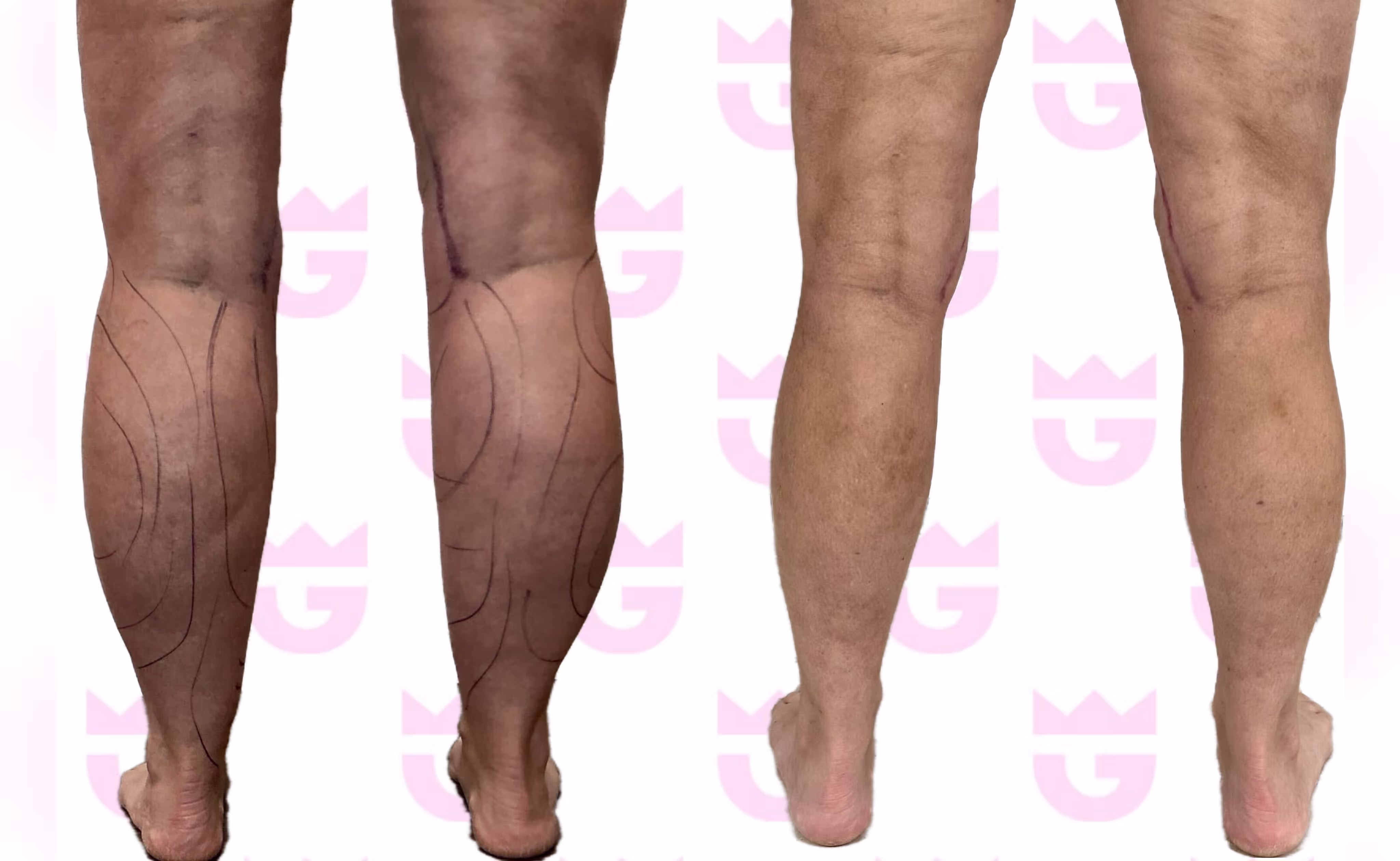 Calf Liposuction Gallery