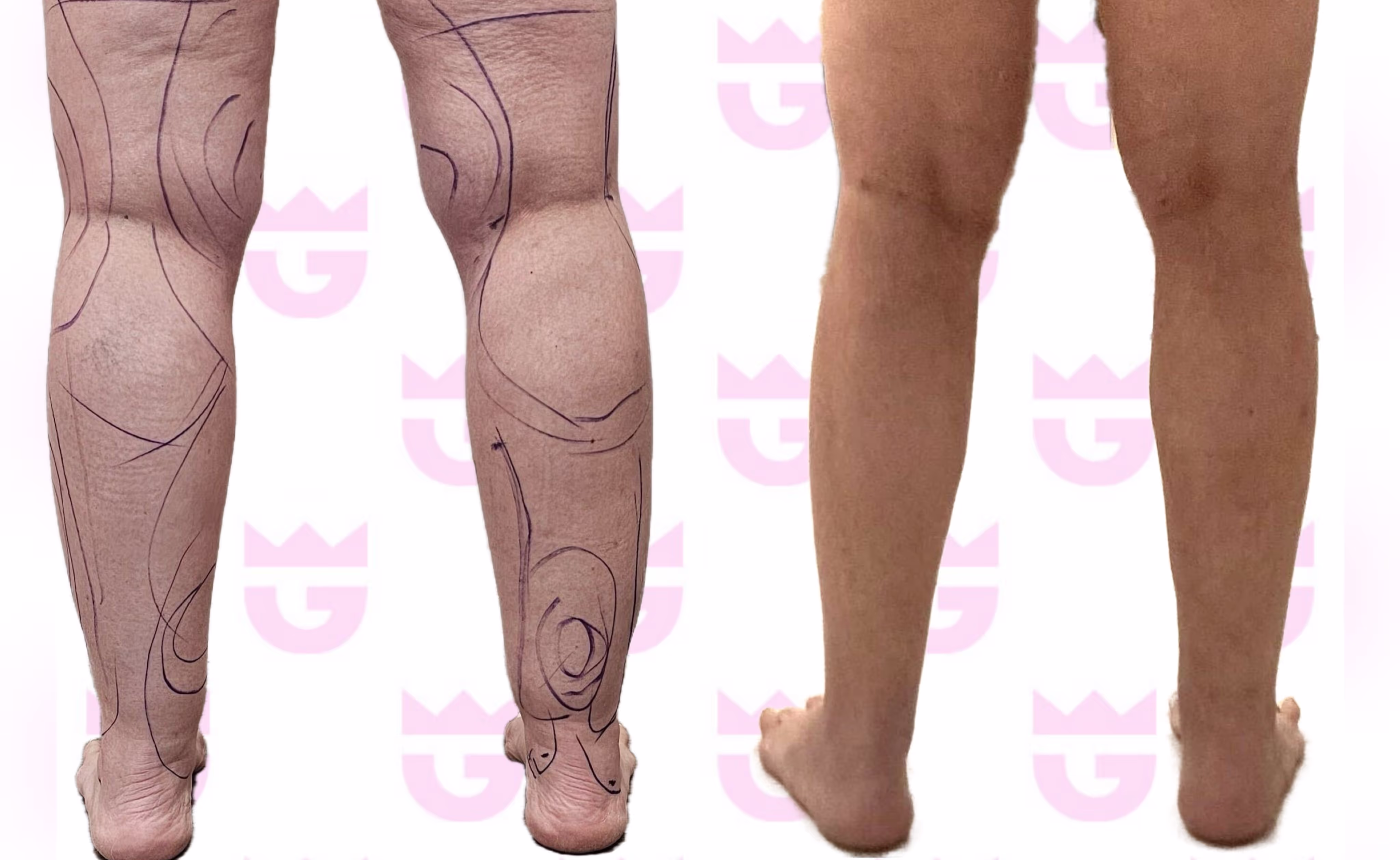 Calf Liposuction Gallery