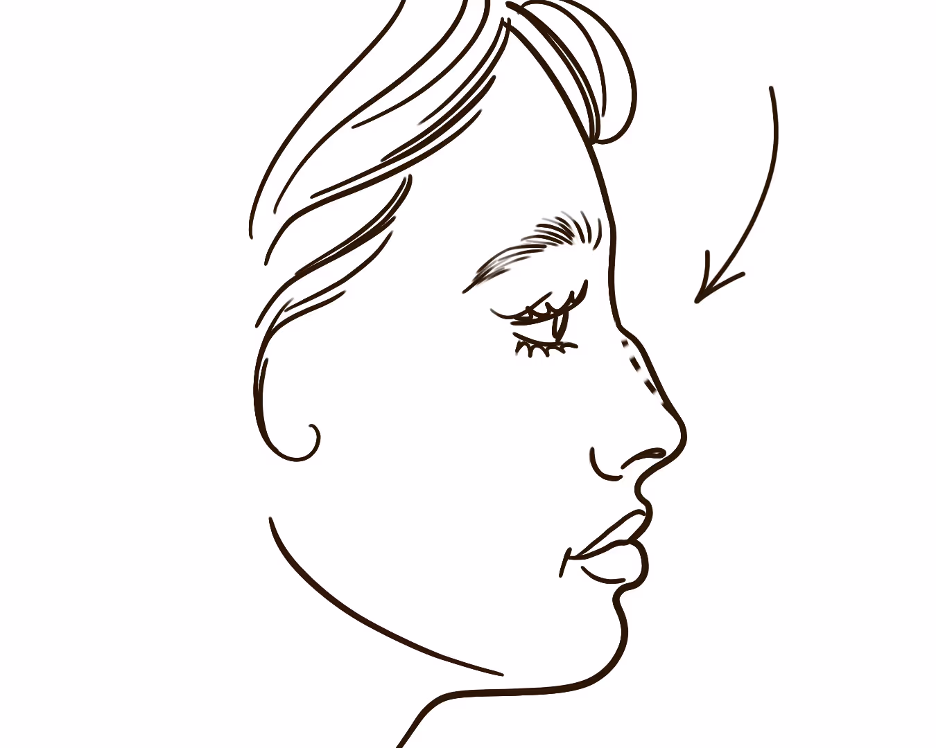 Nose Reshaping