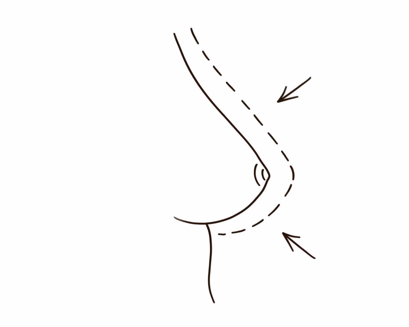 Breast Reduction