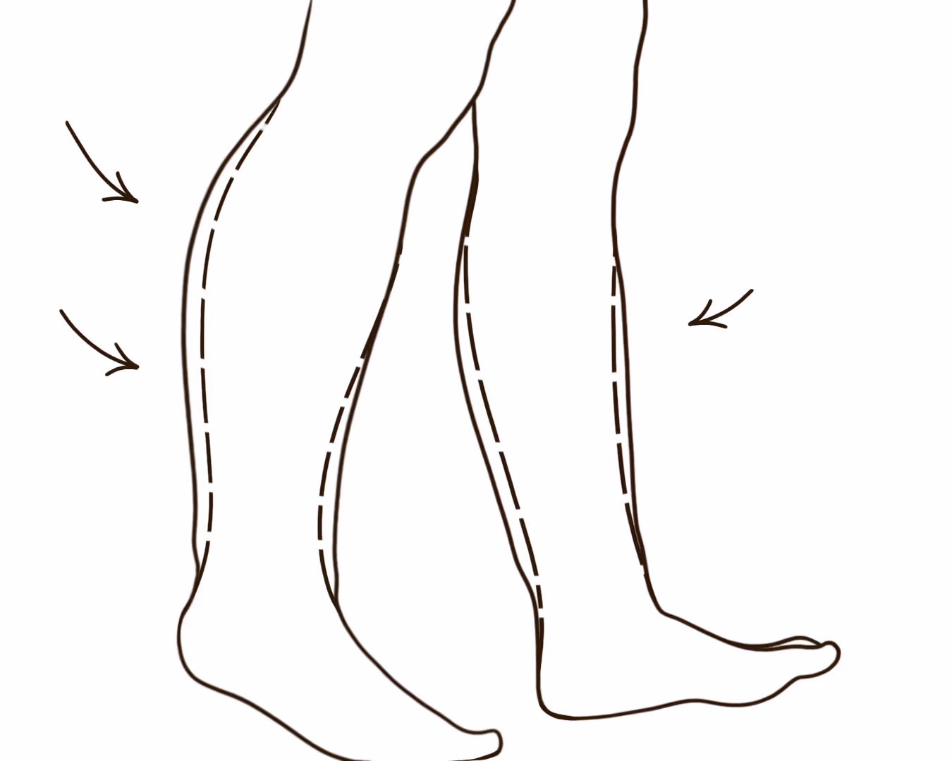 Leg Fat Deposits