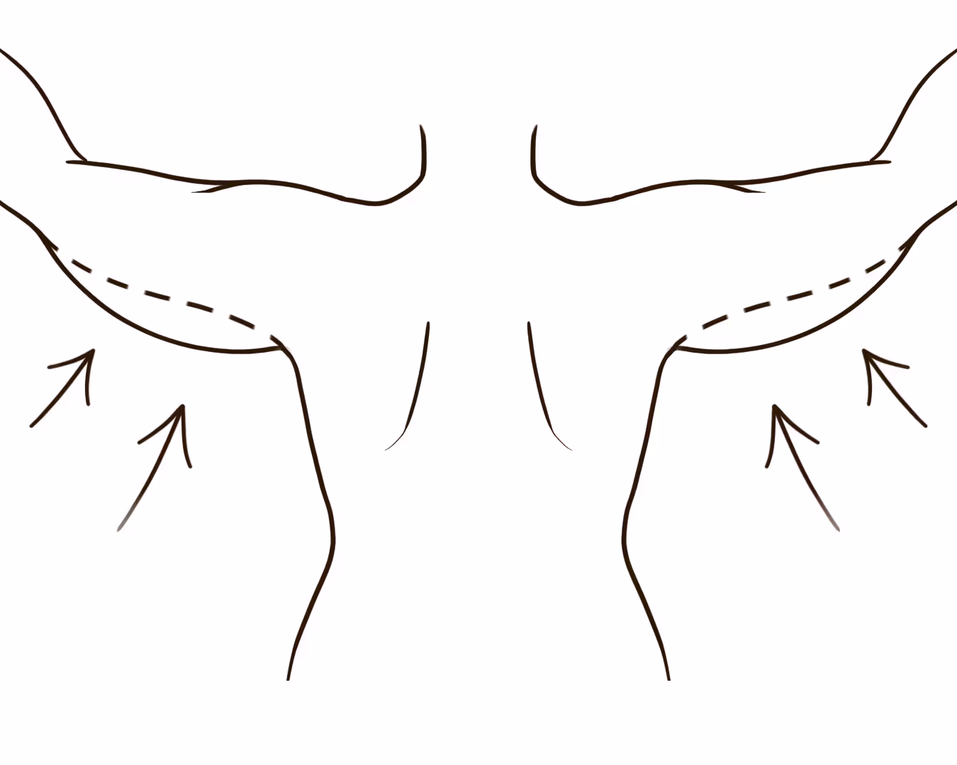 Scar Revision