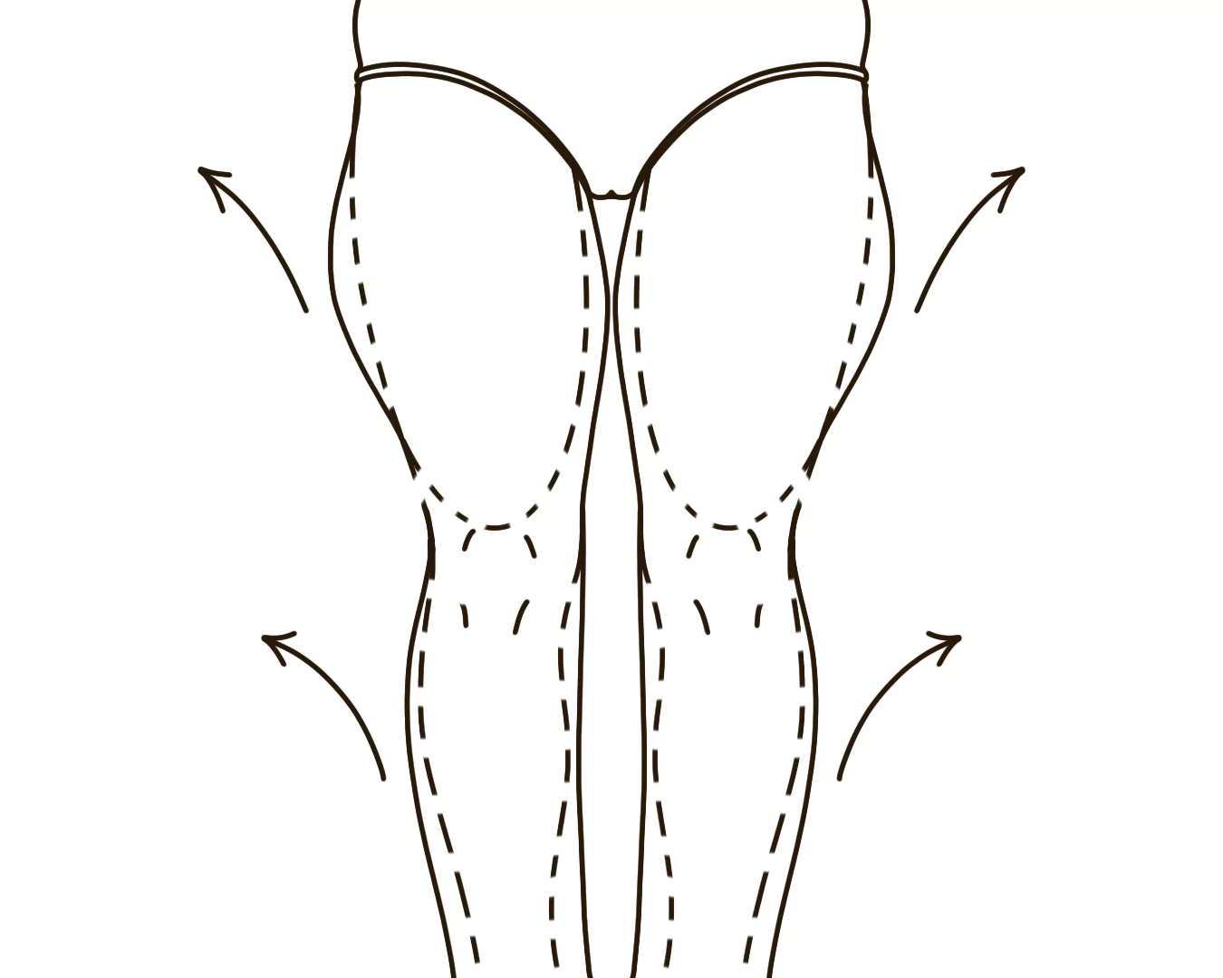 Leg Laxity Post-Lipedema Treatment