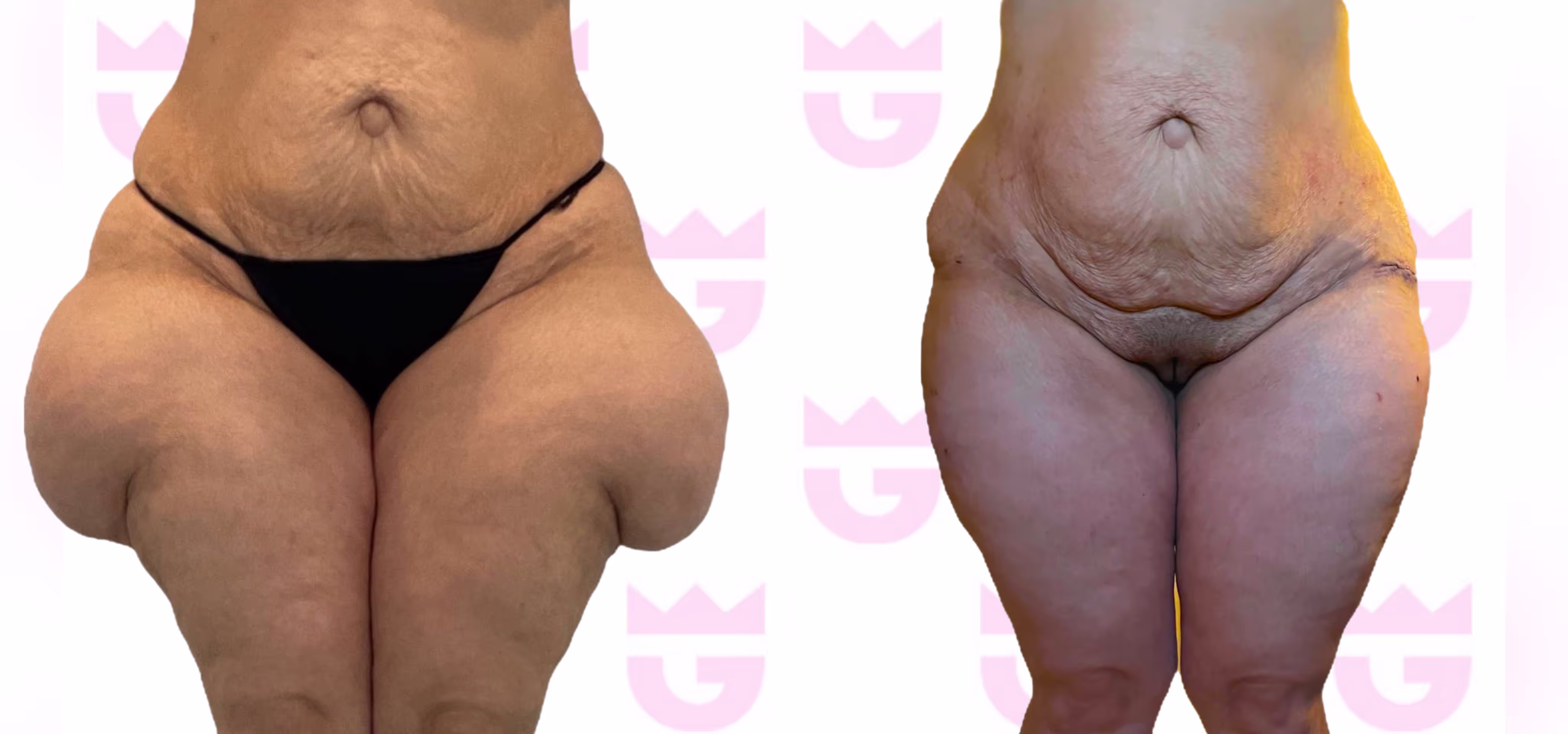 Lipedema Lift Gallery