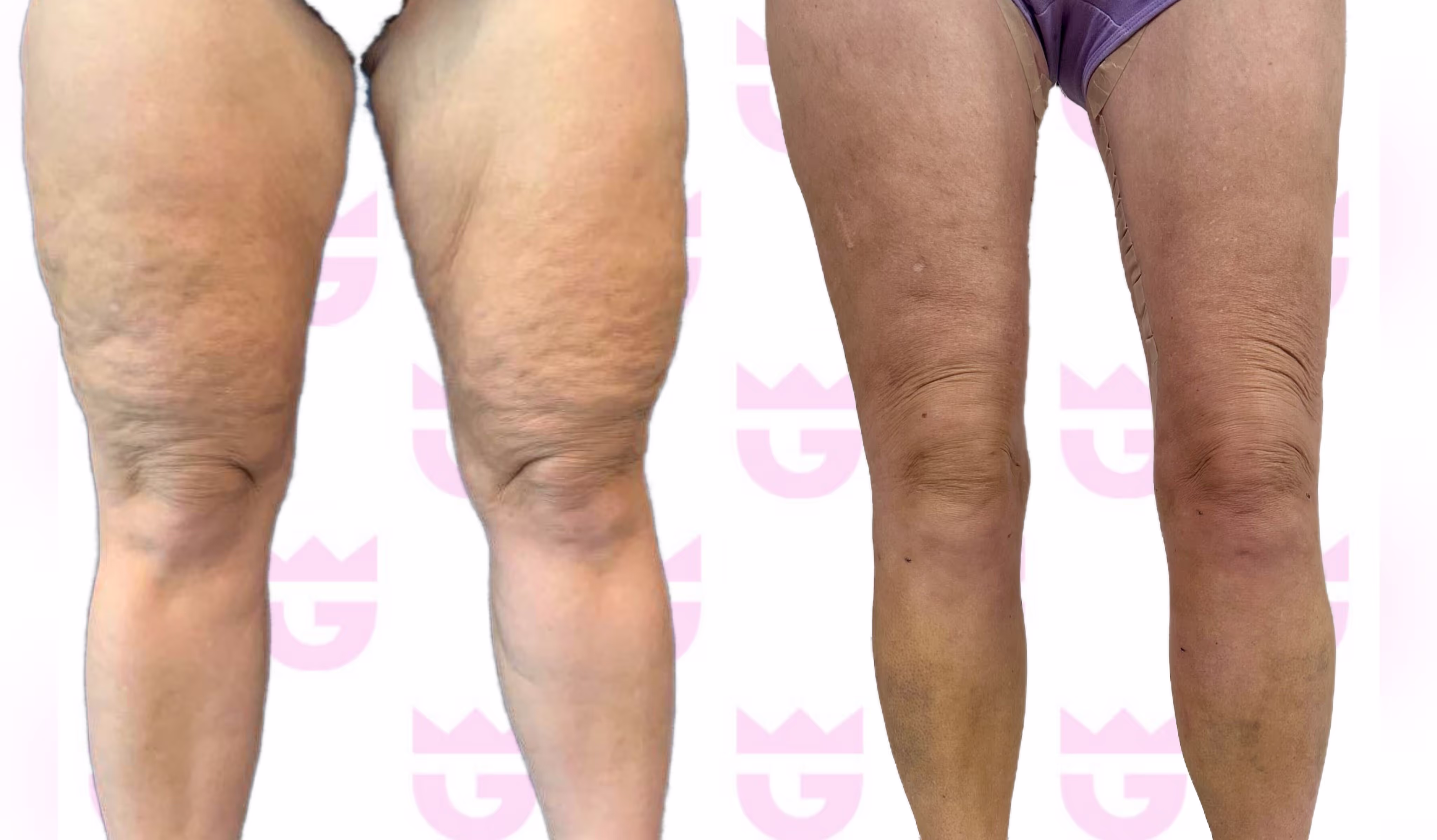 Lipedema Lift Gallery