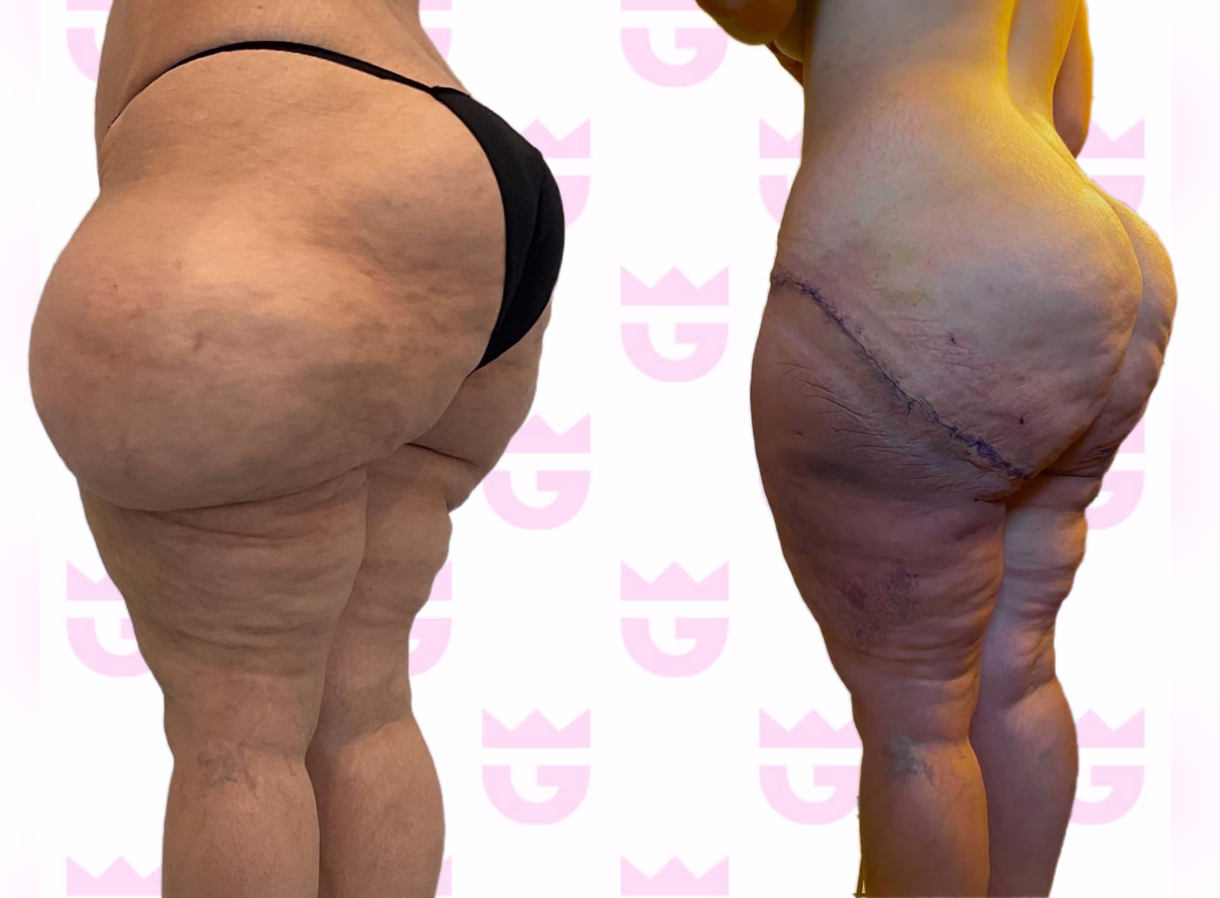 Lipedema Lift Gallery