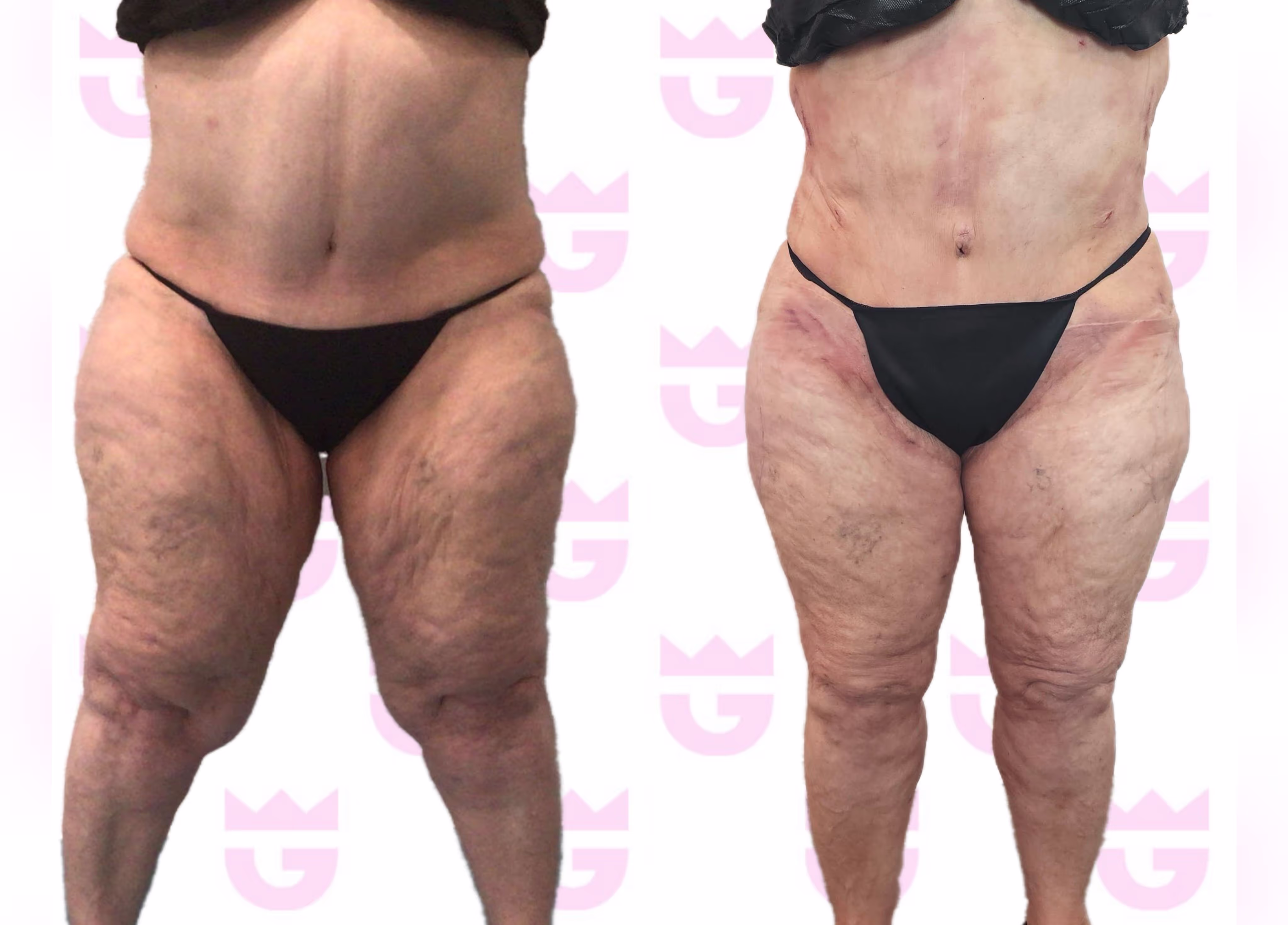 Lipedema Lift Gallery