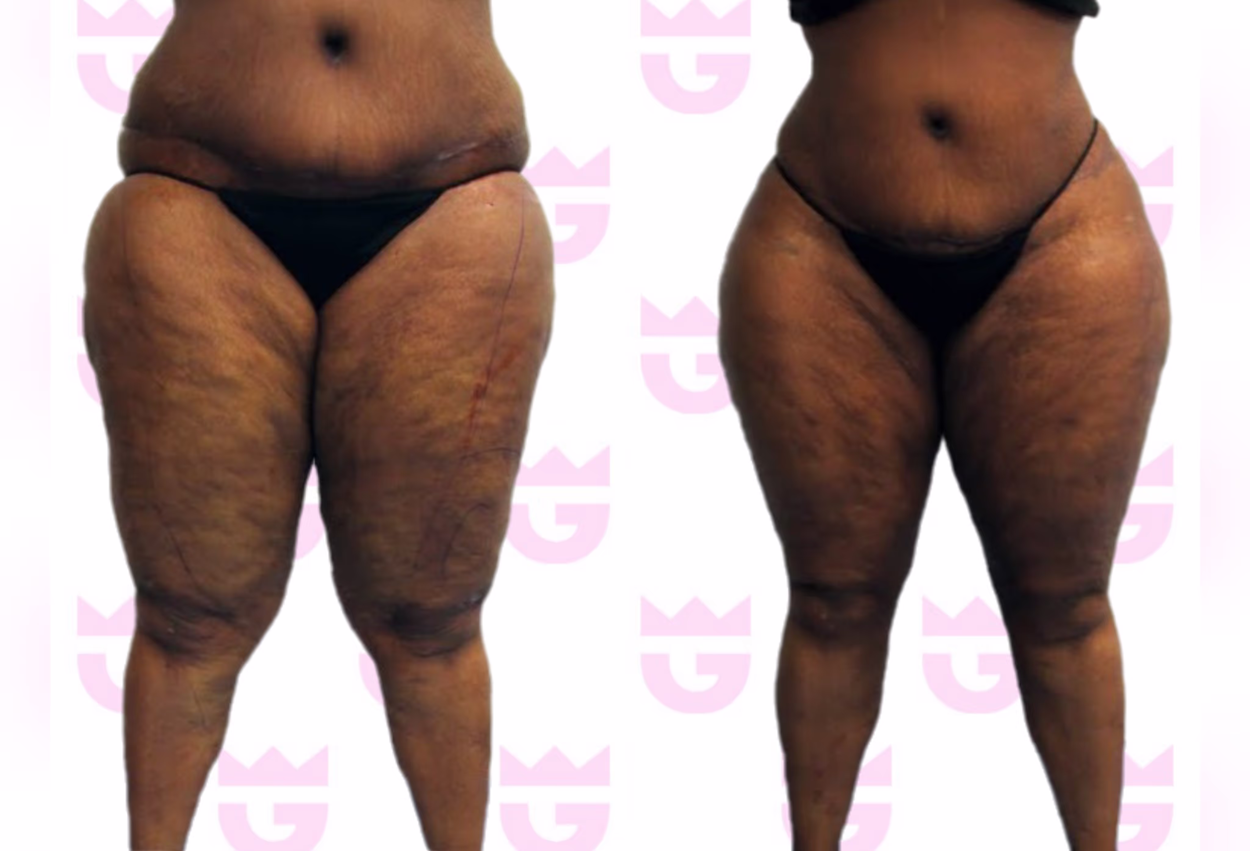 Lipedema Liposuction