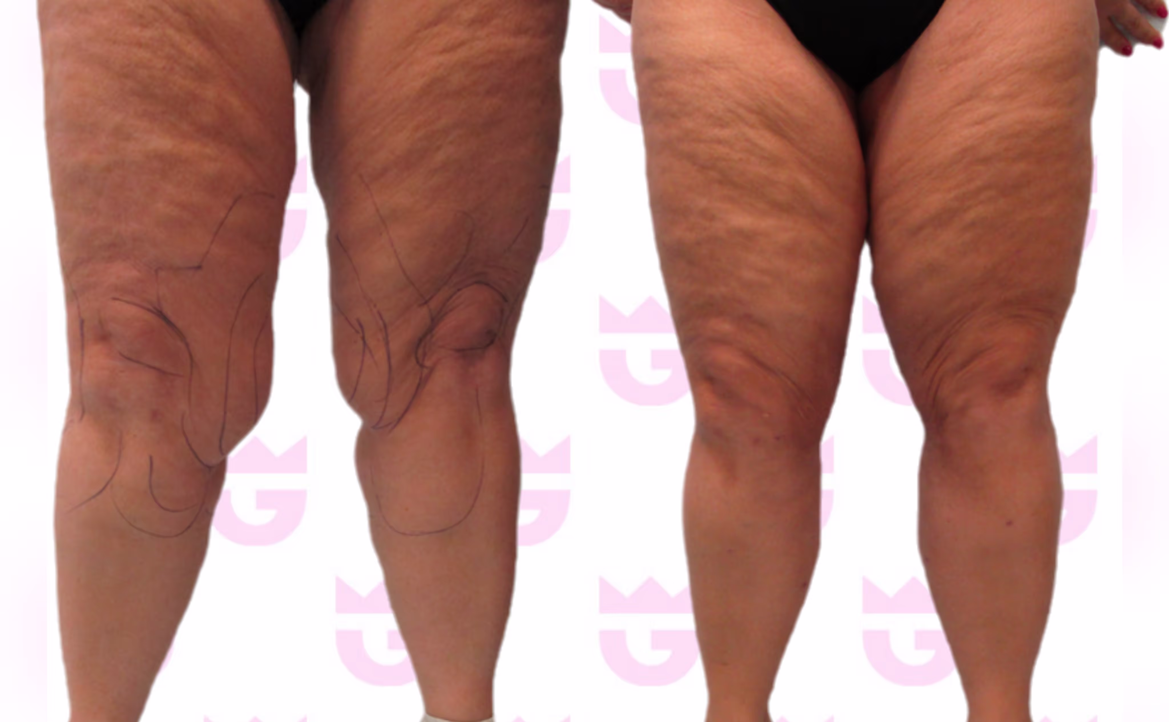 Lipedema Liposuction