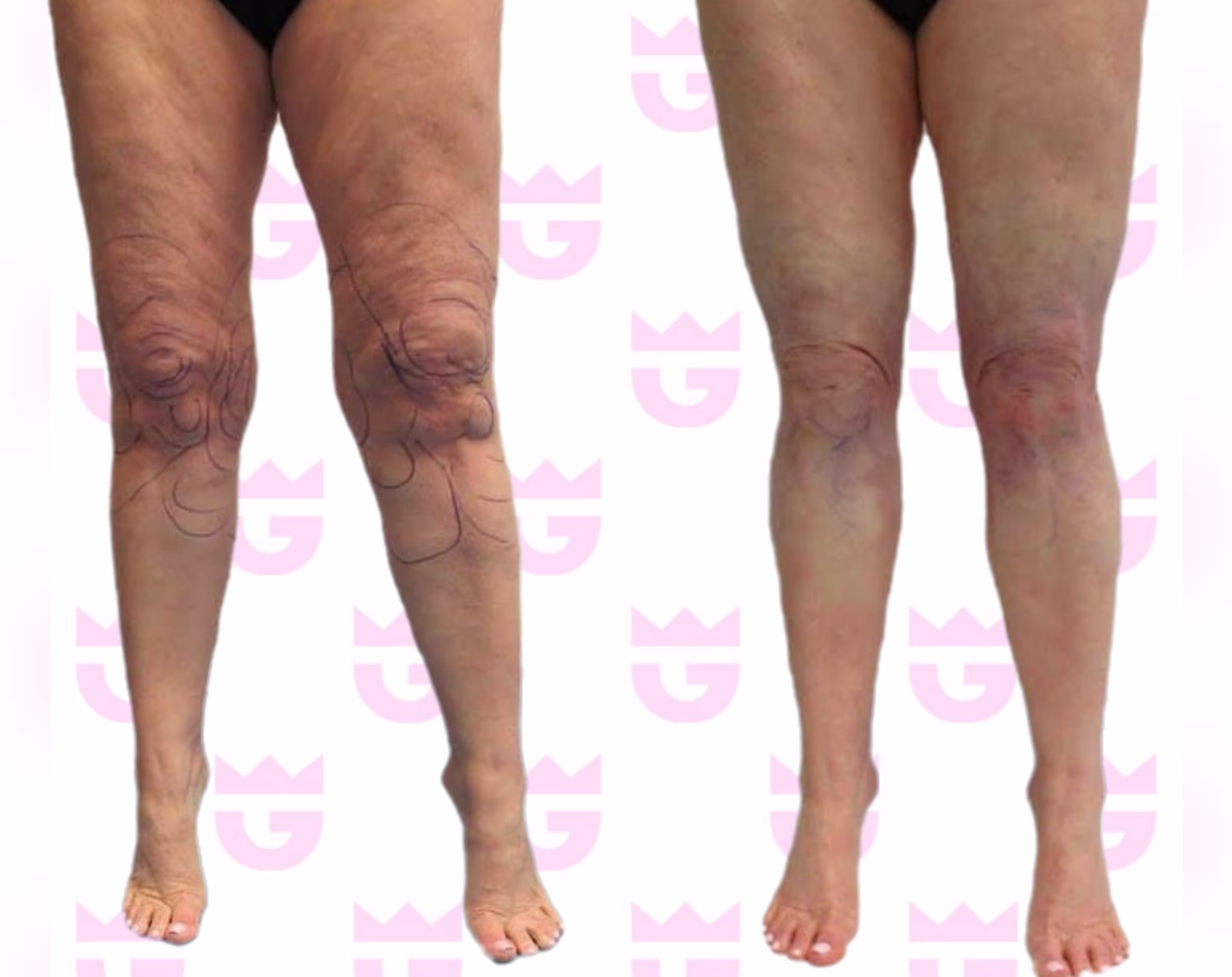 Lipedema Liposuction