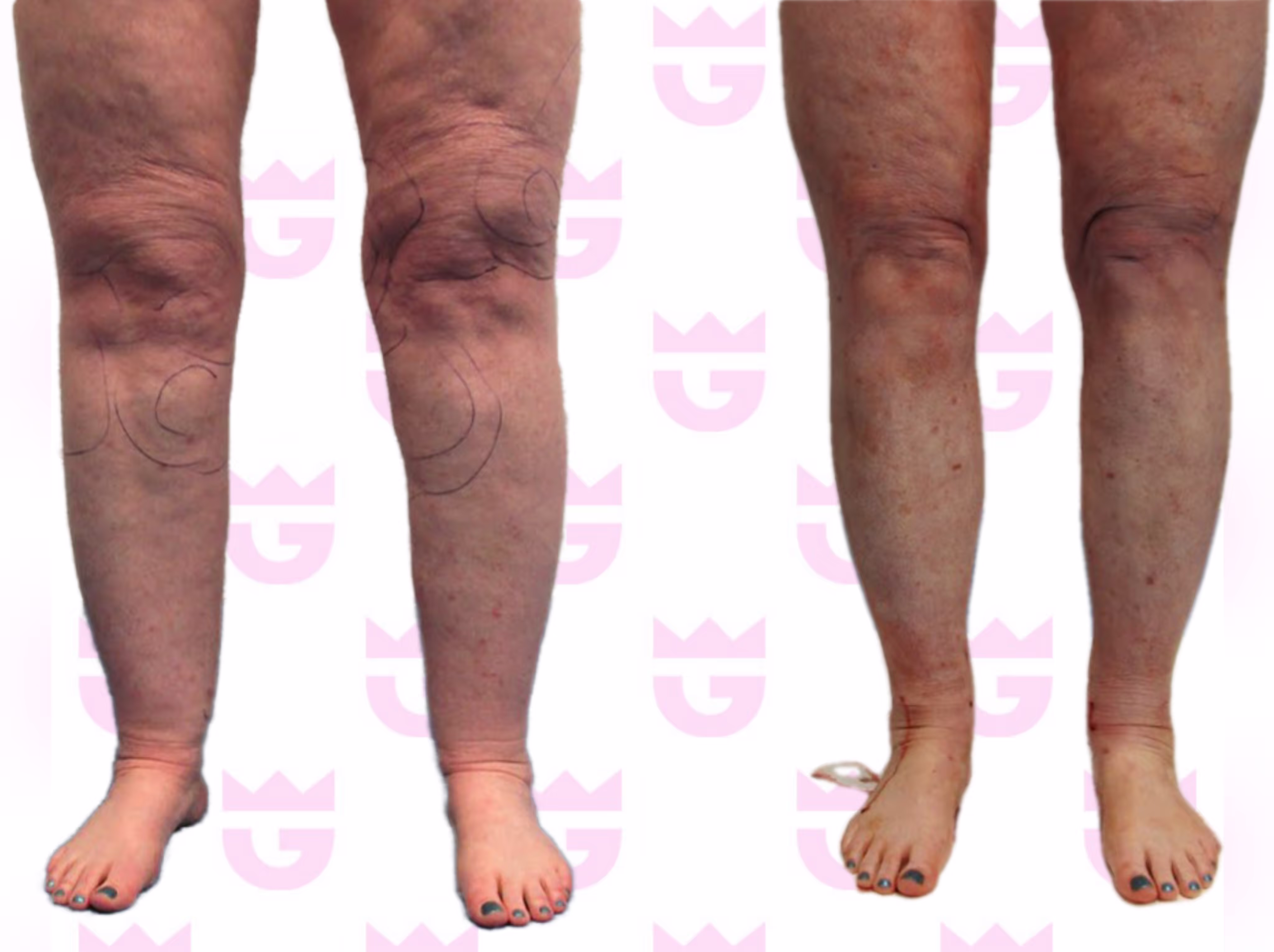 Lipedema Liposuction
