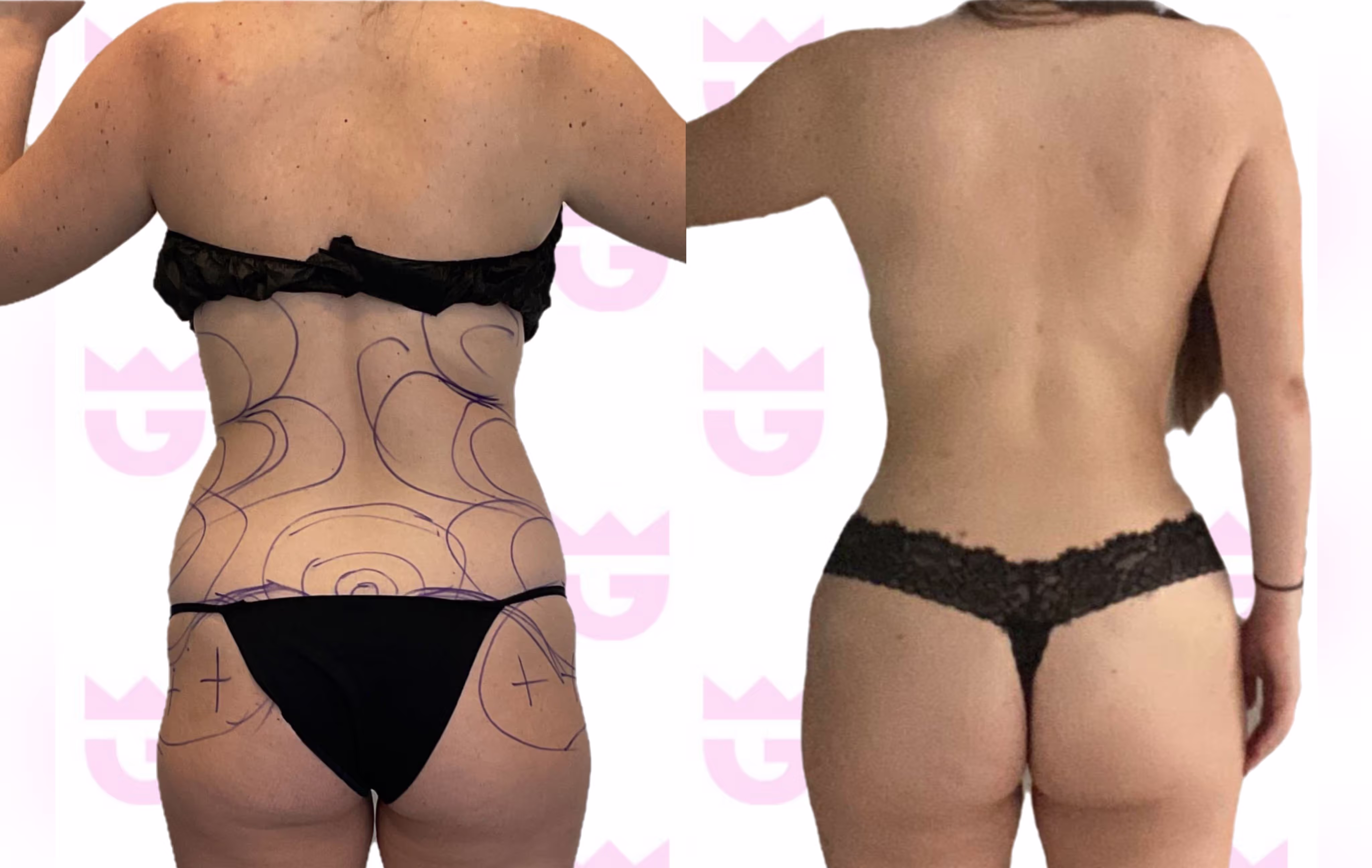 Brazilian Butt Lift (BBL) Gallery