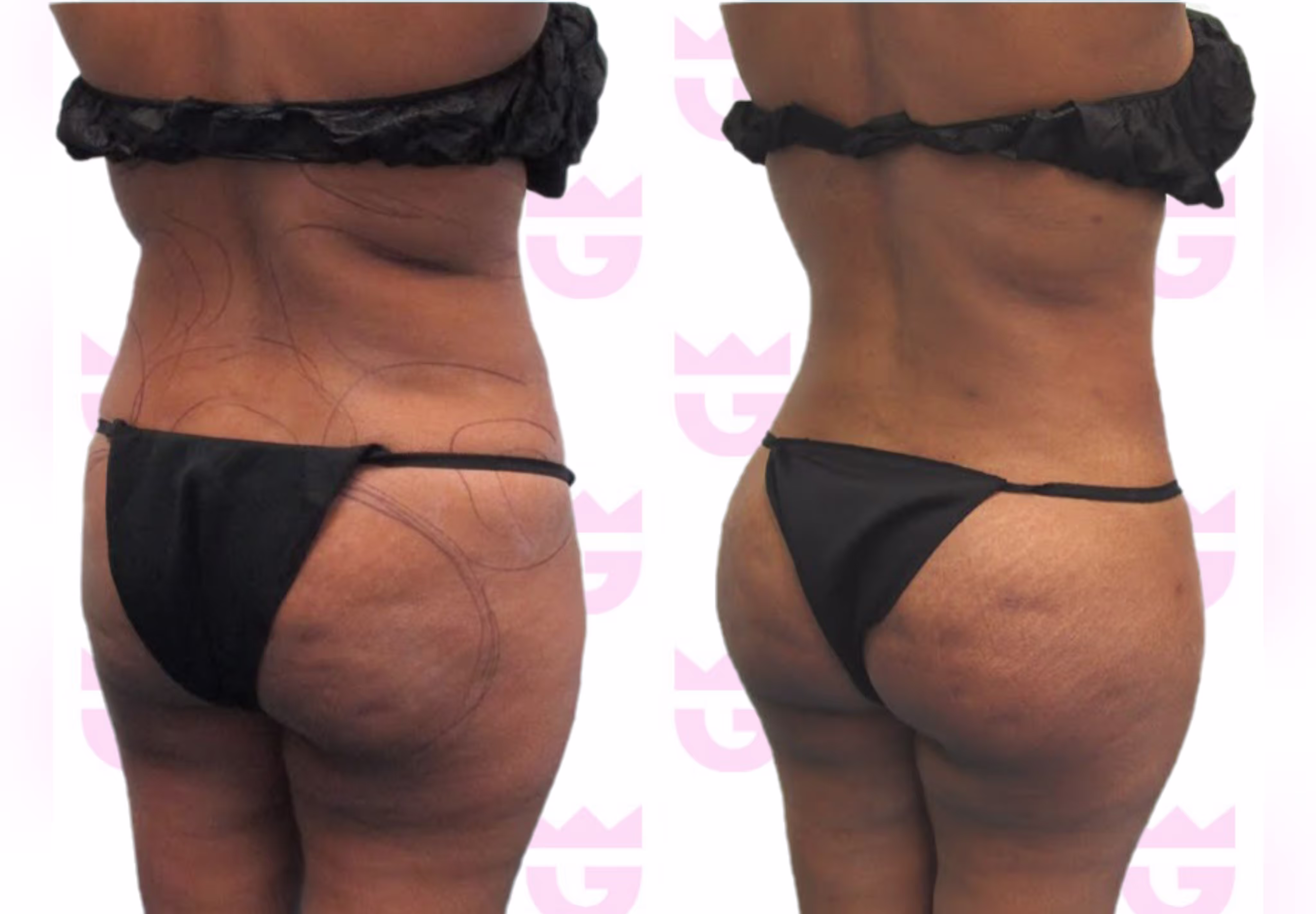 Brazilian Butt Lift (BBL) Gallery