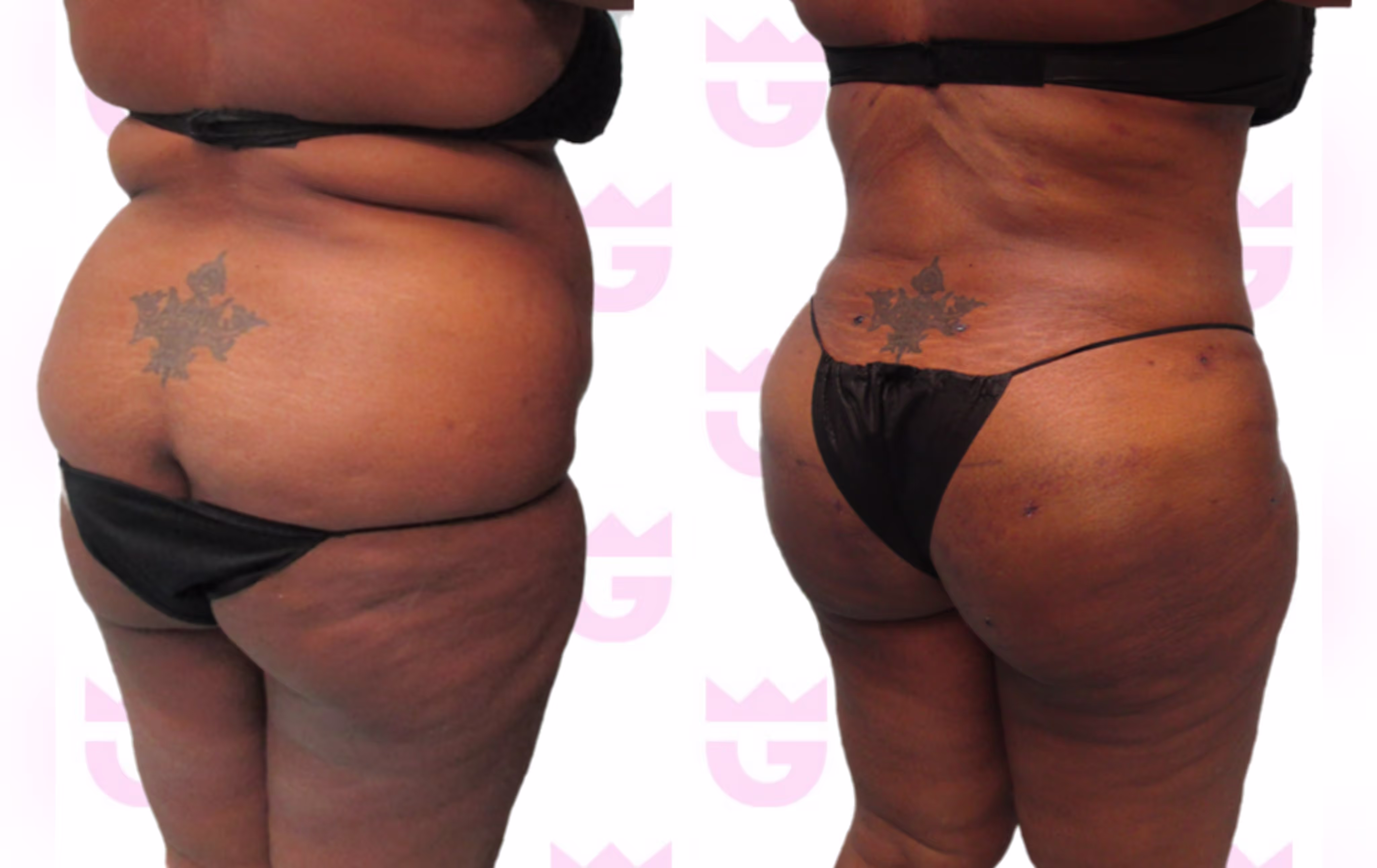 Brazilian Butt Lift (BBL) Gallery
