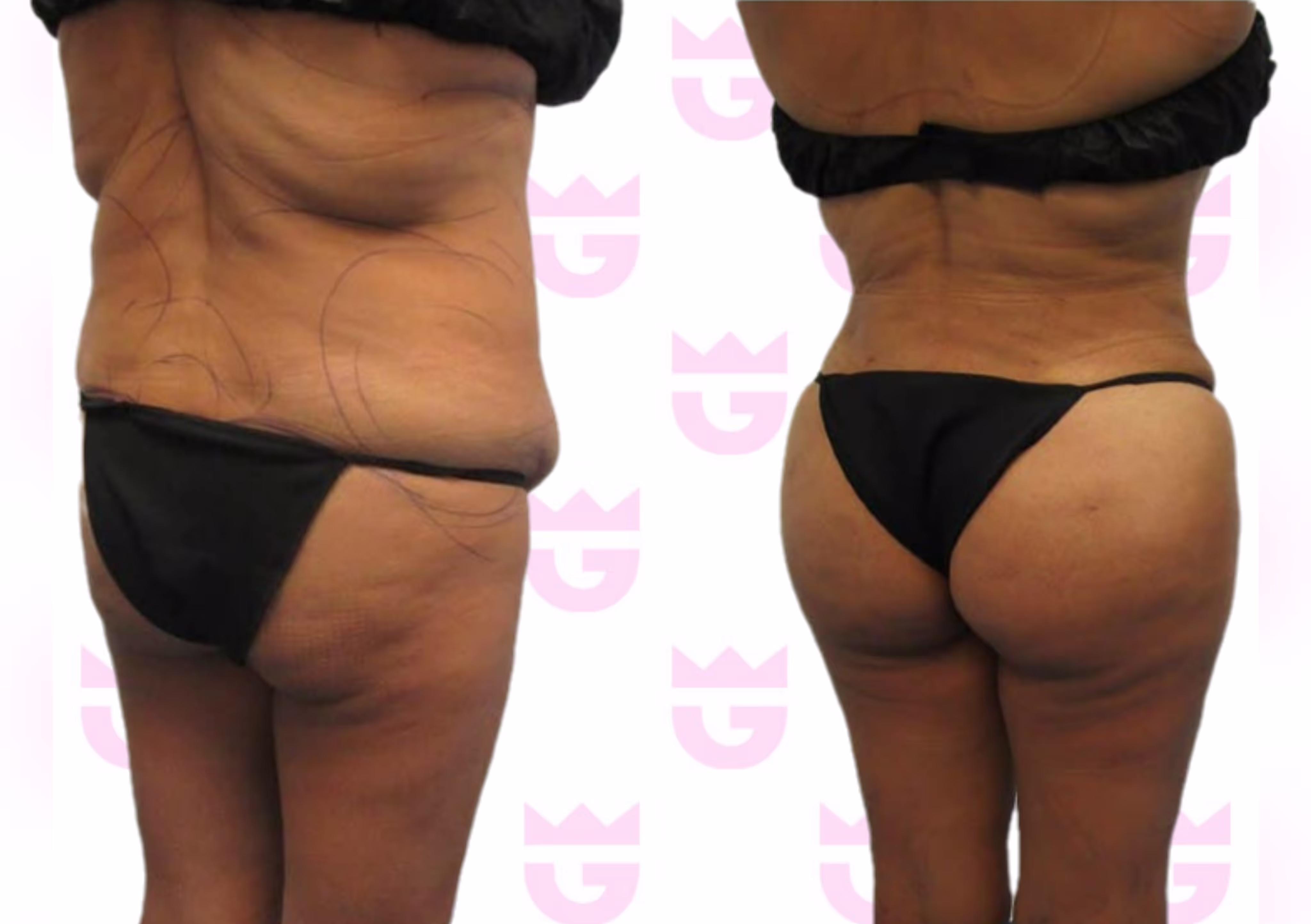 Brazilian Butt Lift (BBL) Gallery