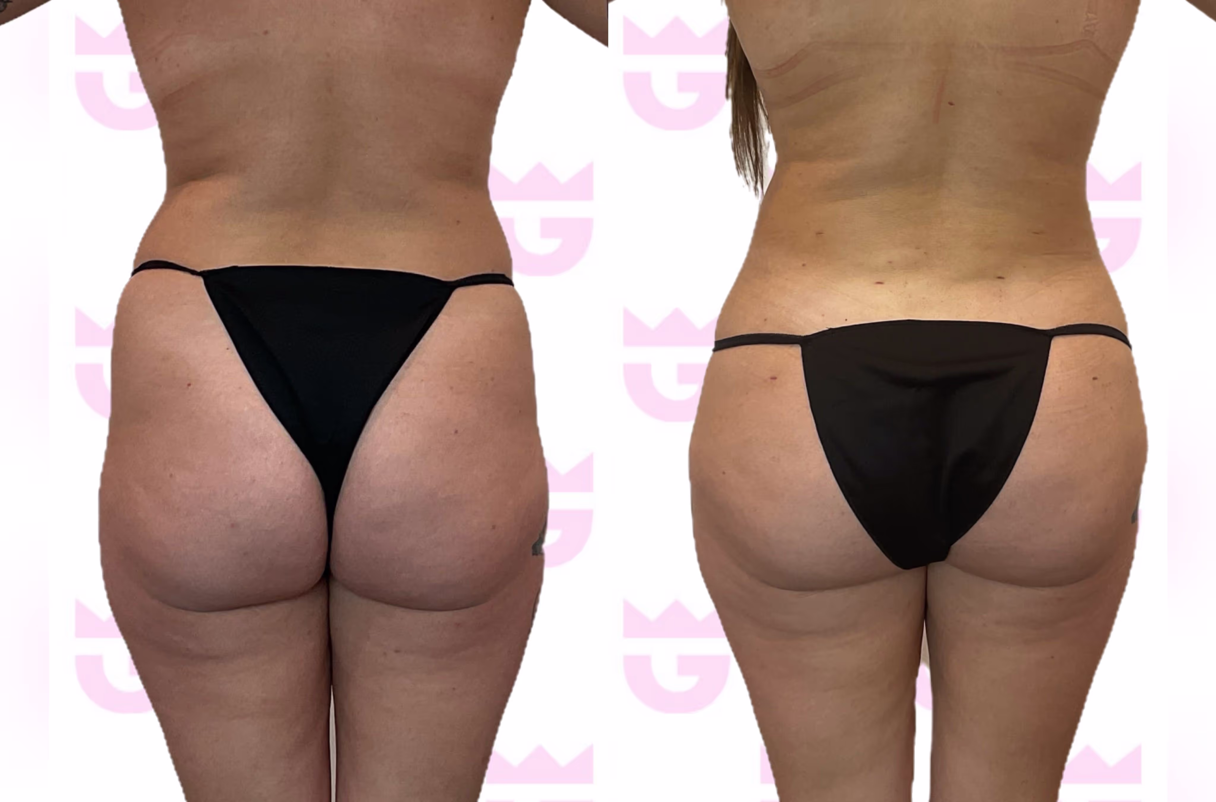 Brazilian Butt Lift (BBL) Gallery