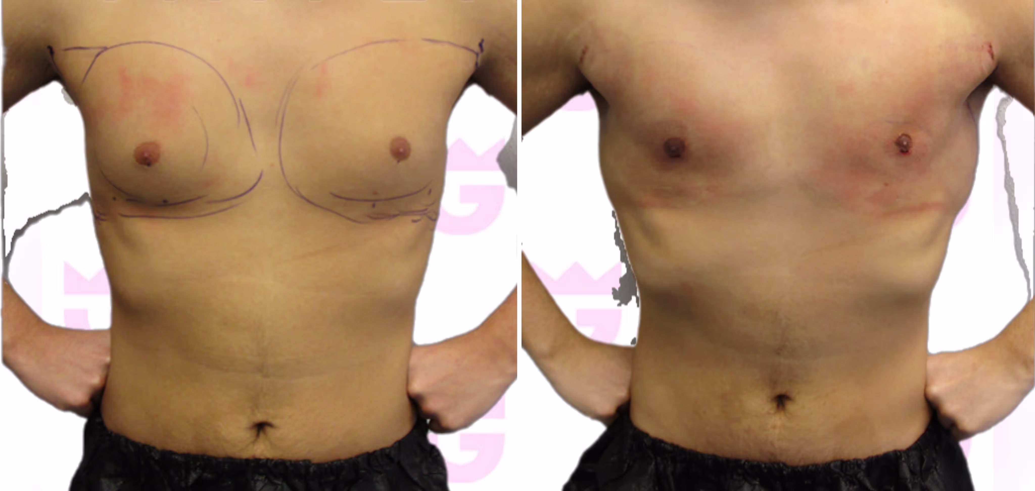 Gynecomastia Gallery