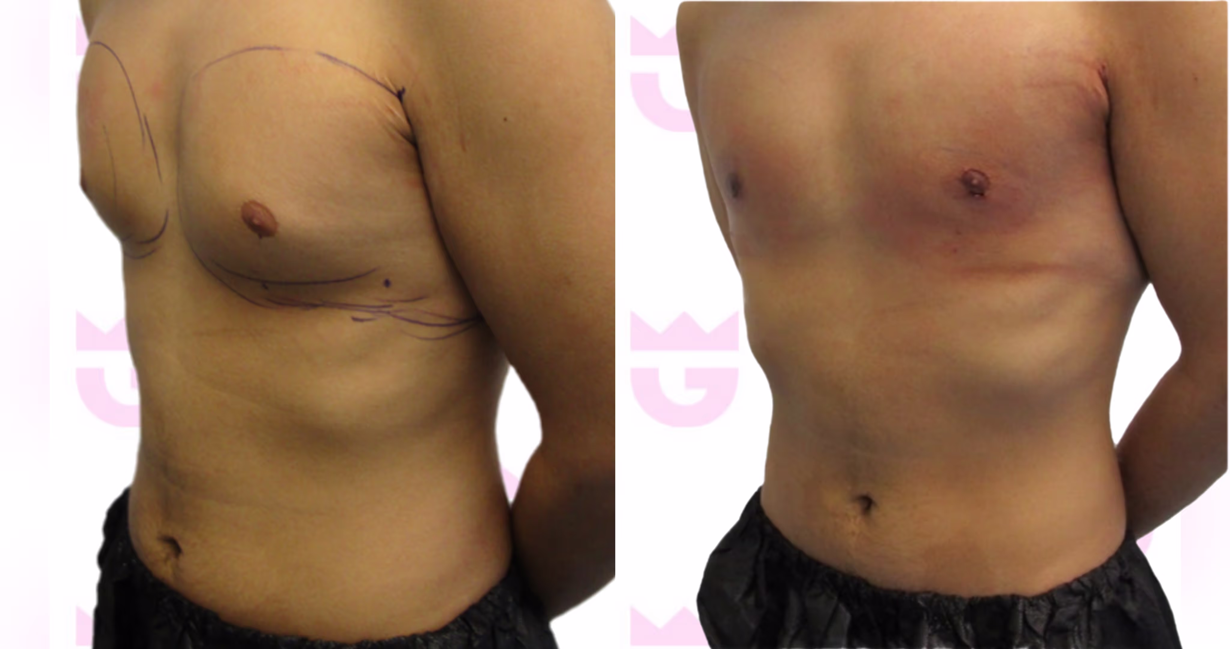 Gynecomastia Gallery