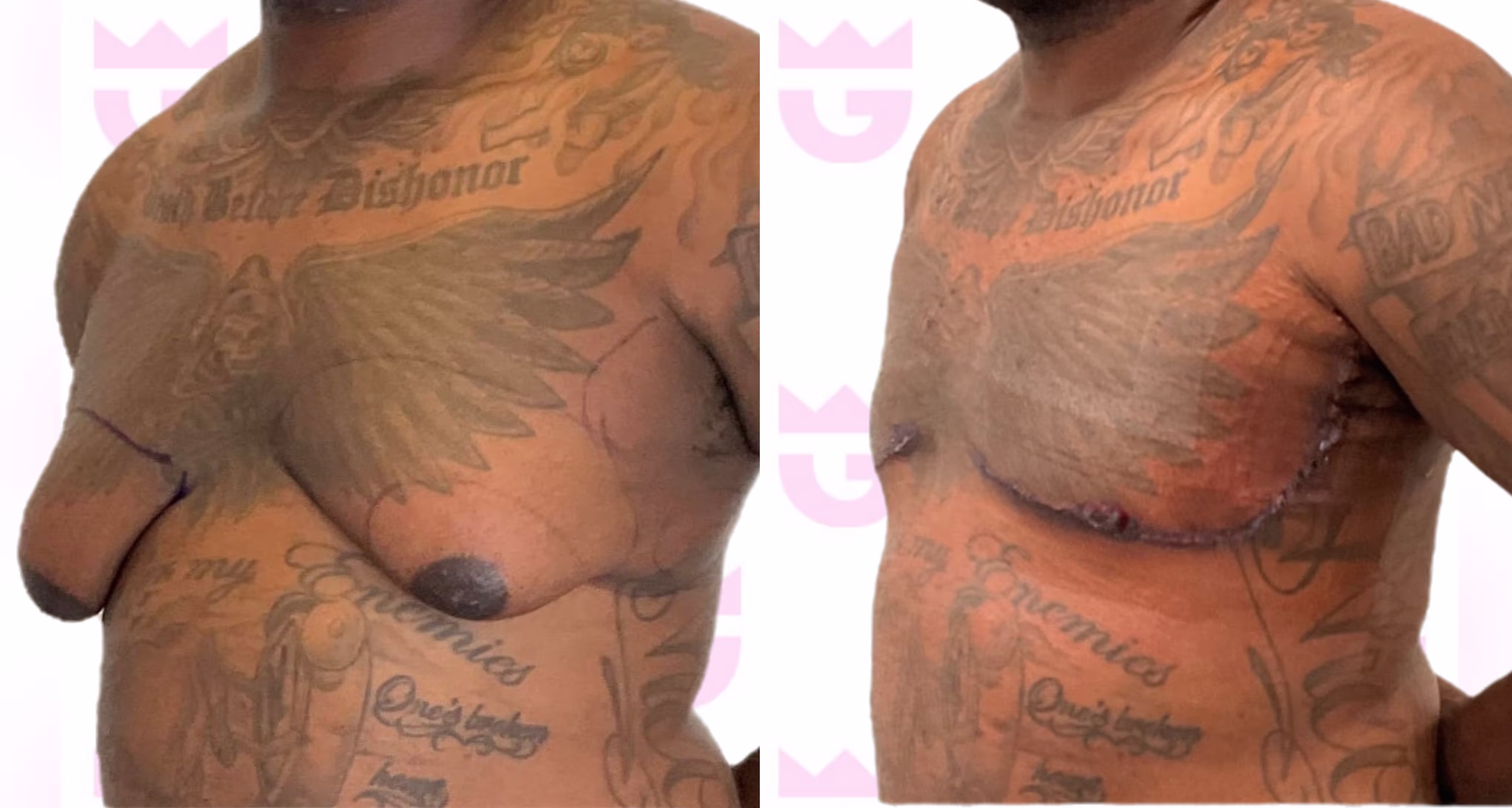 Gynecomastia Gallery