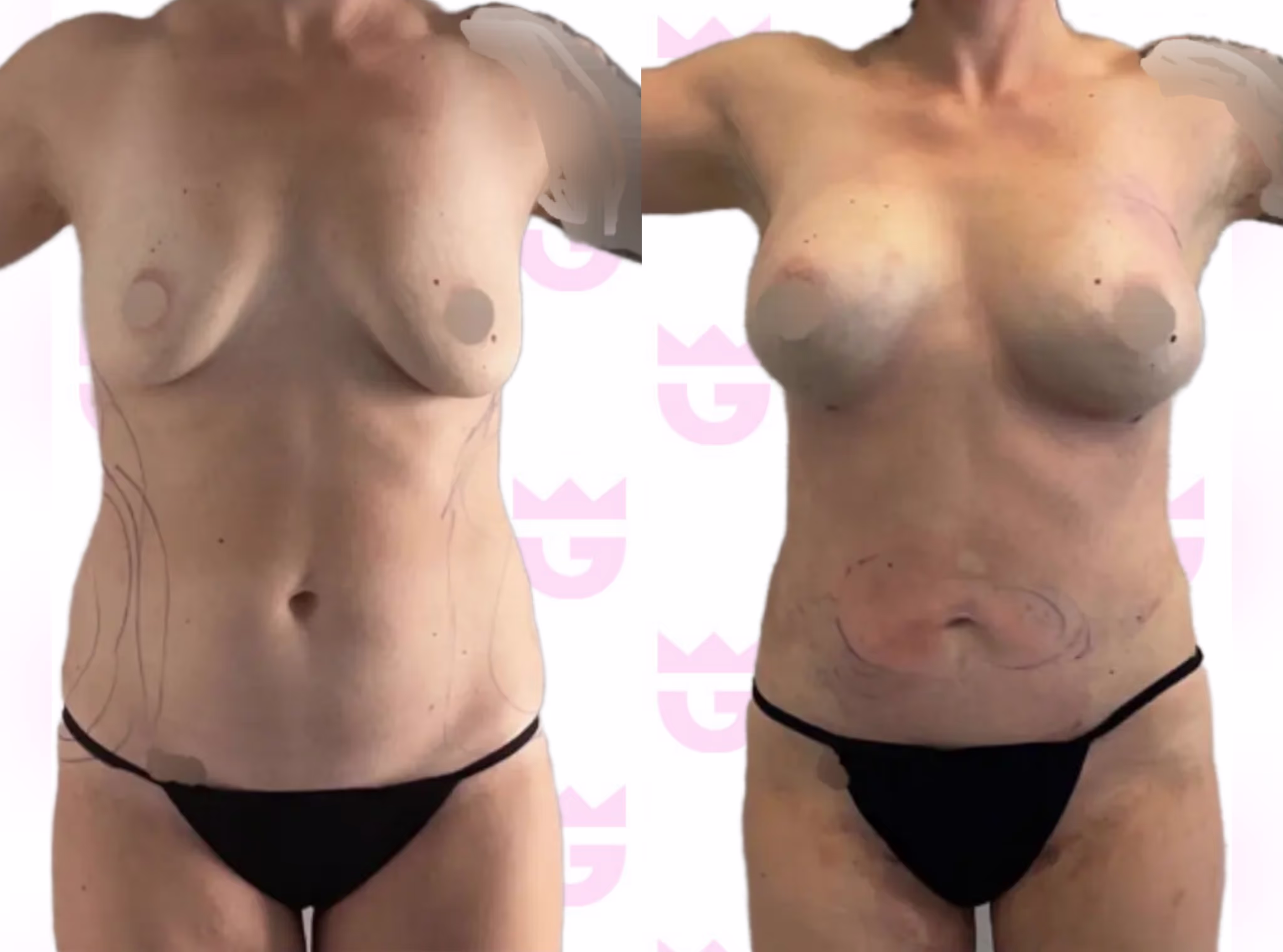 Mommy Makeover Gallery