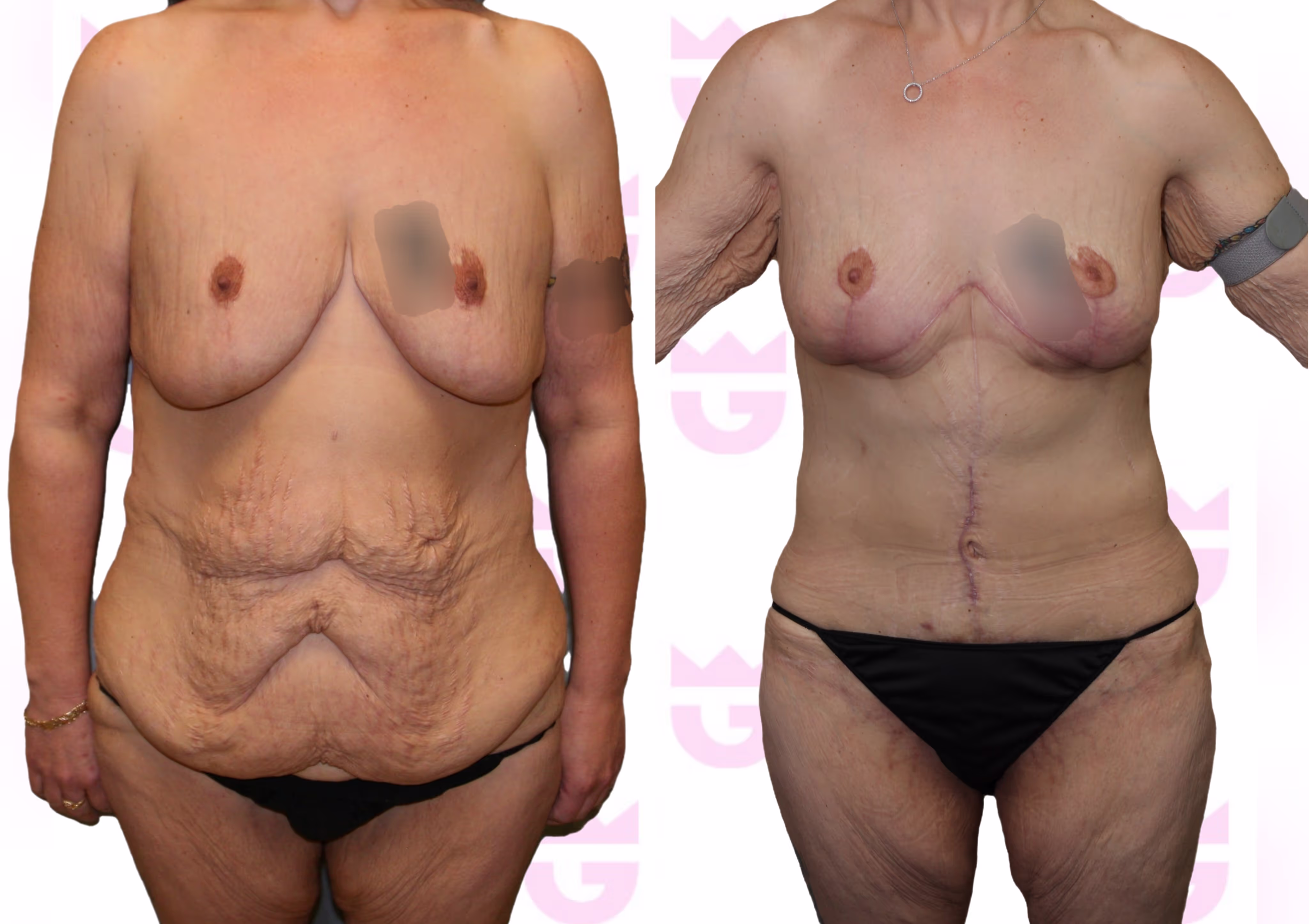 Mommy Makeover Gallery