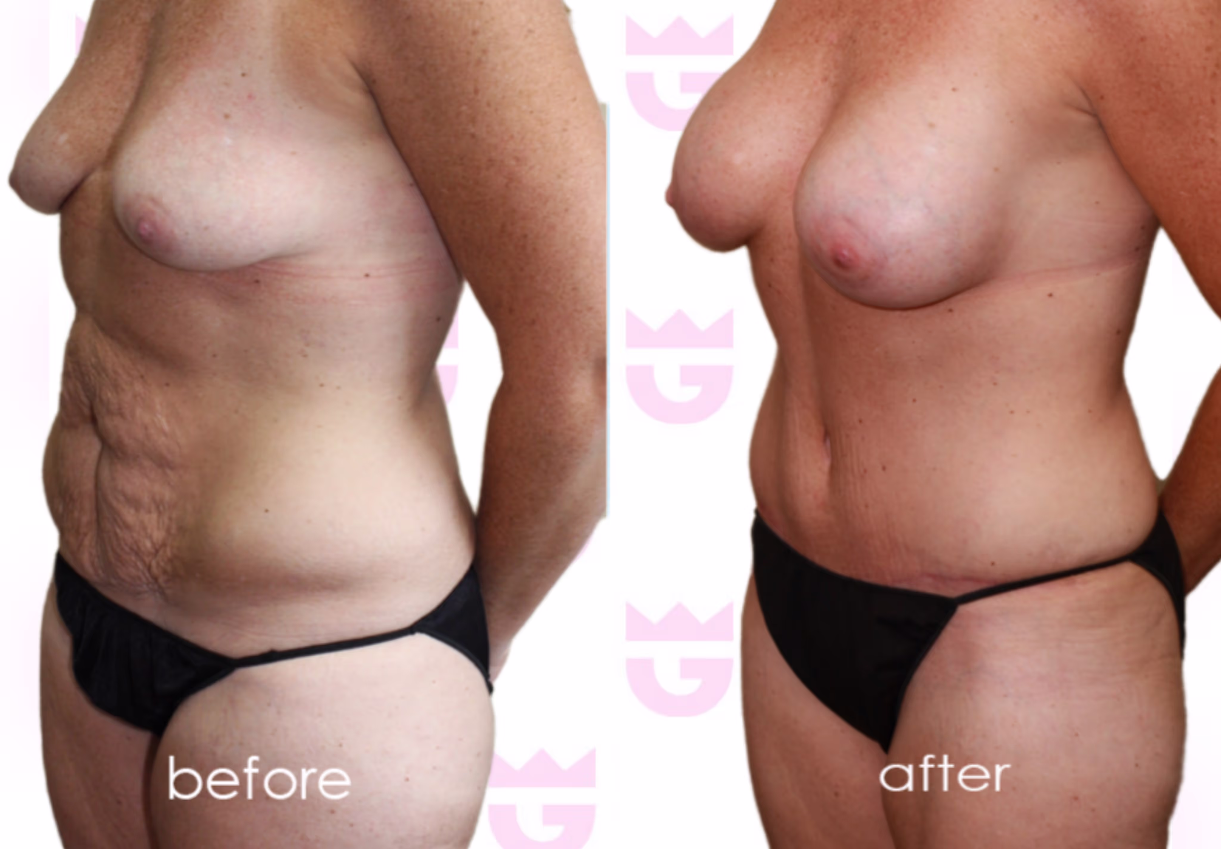 Mommy Makeover Gallery