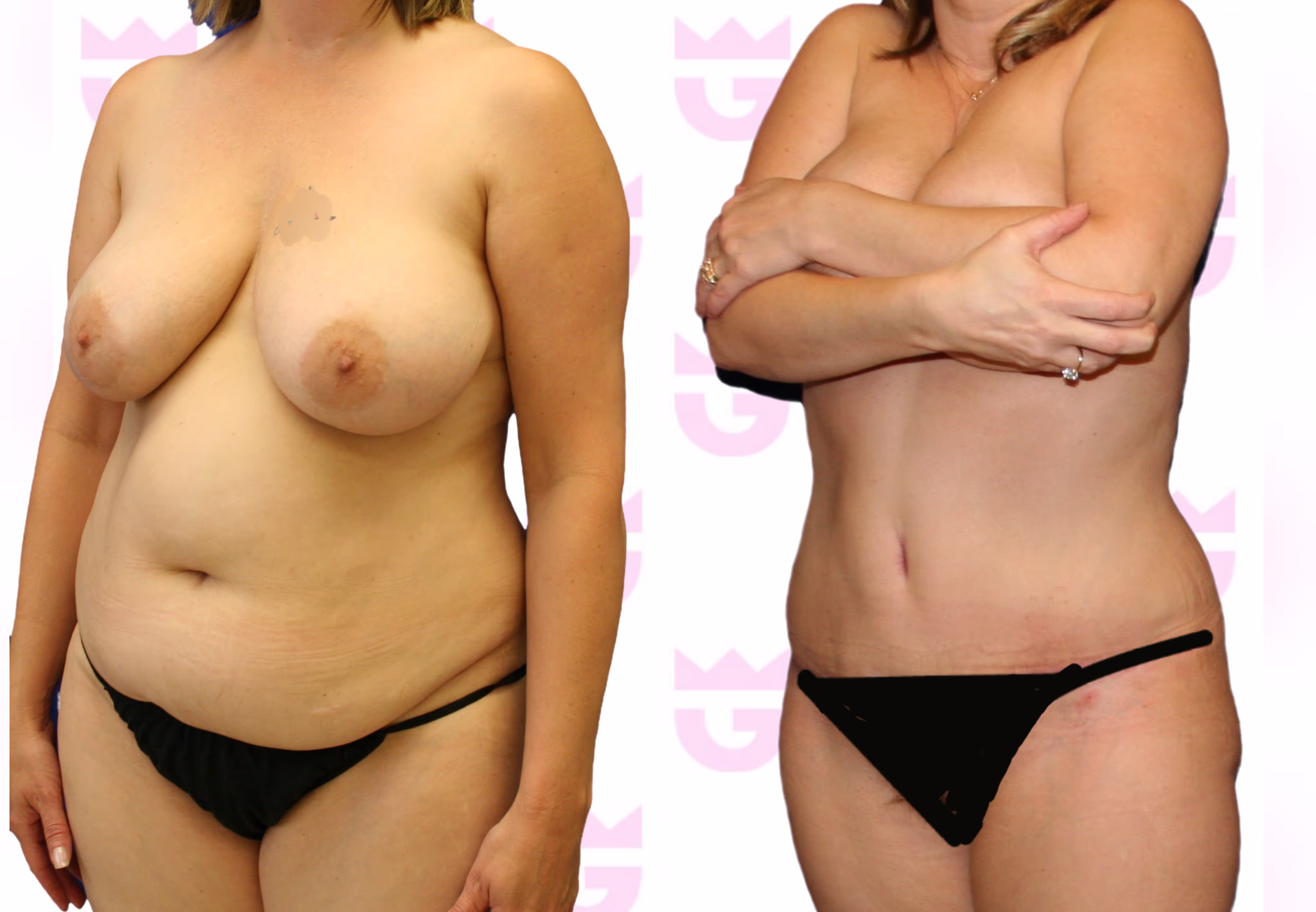Mommy Makeover Gallery