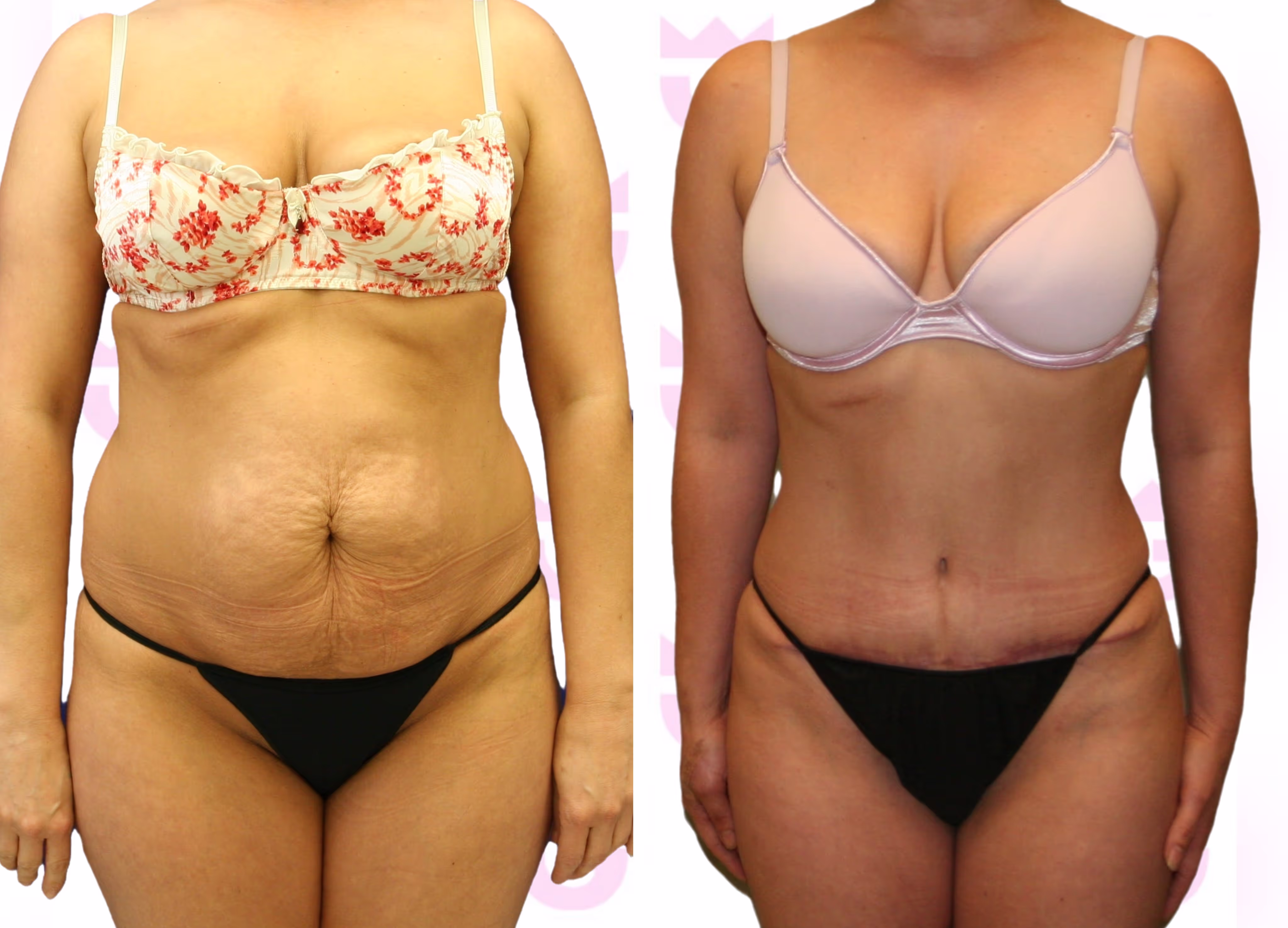 Mommy Makeover Gallery