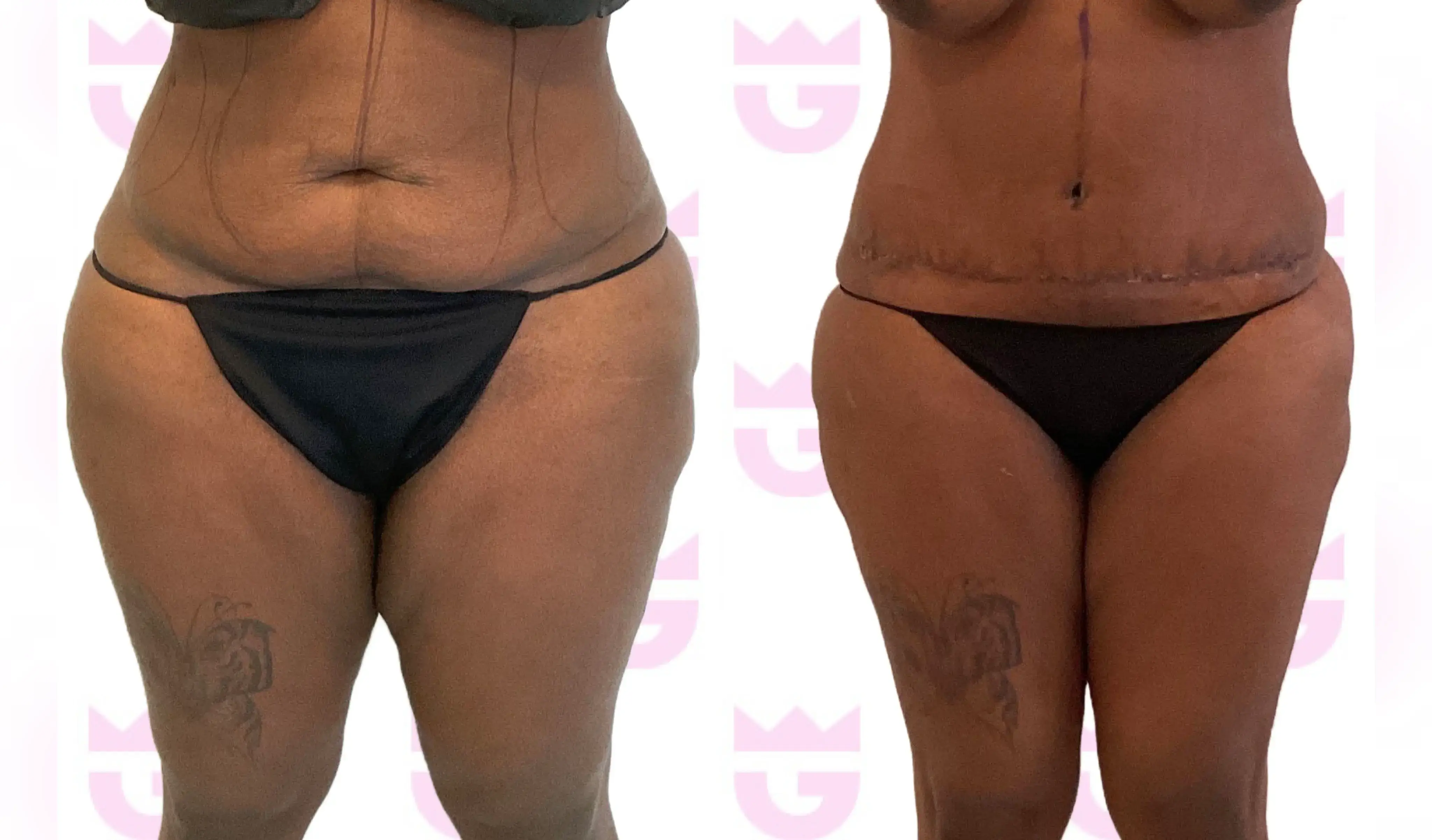 Tummy Tuck (Abdominoplasty) Gallery