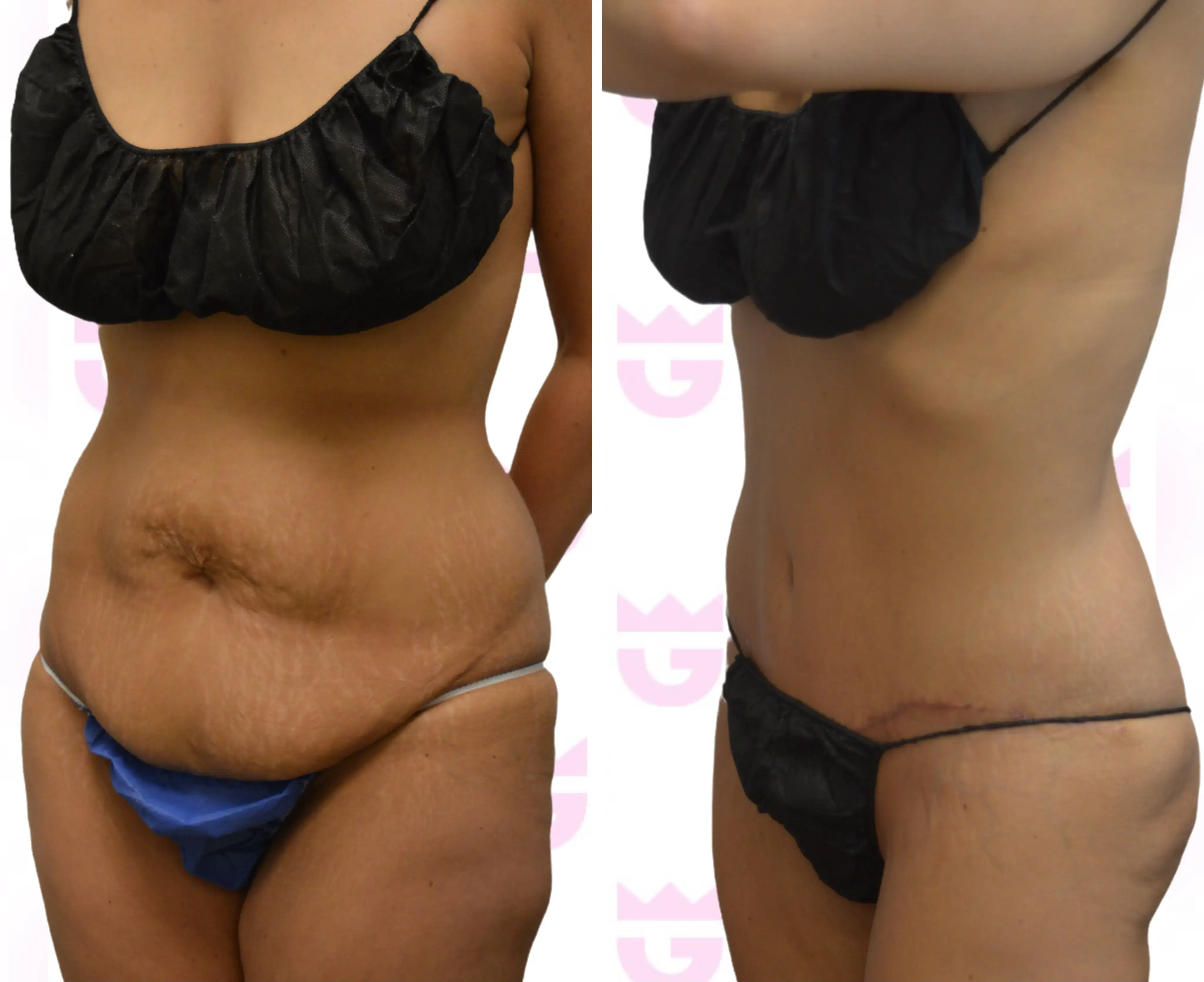 Tummy Tuck (Abdominoplasty) Gallery