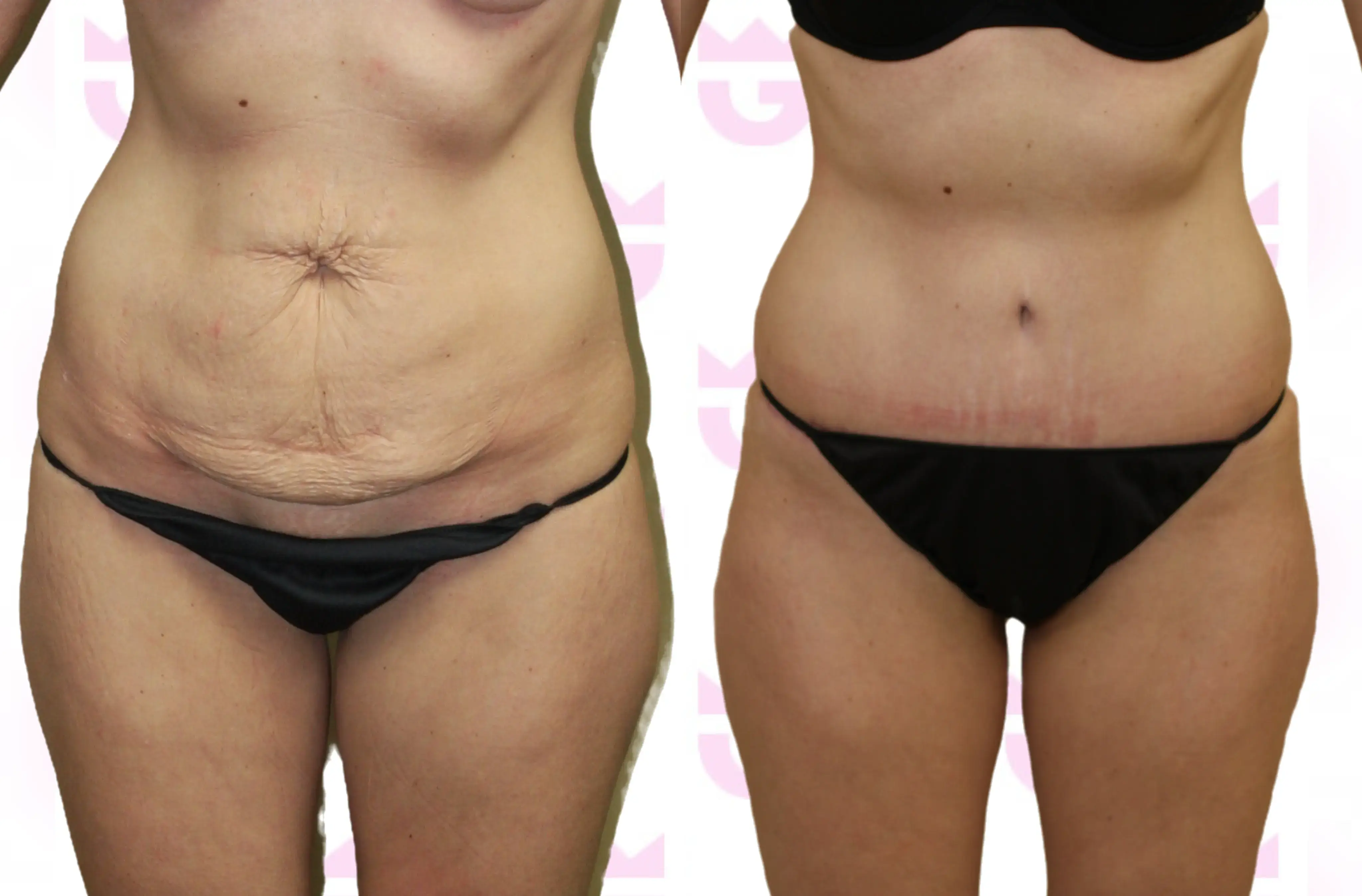Tummy Tuck (Abdominoplasty) Gallery