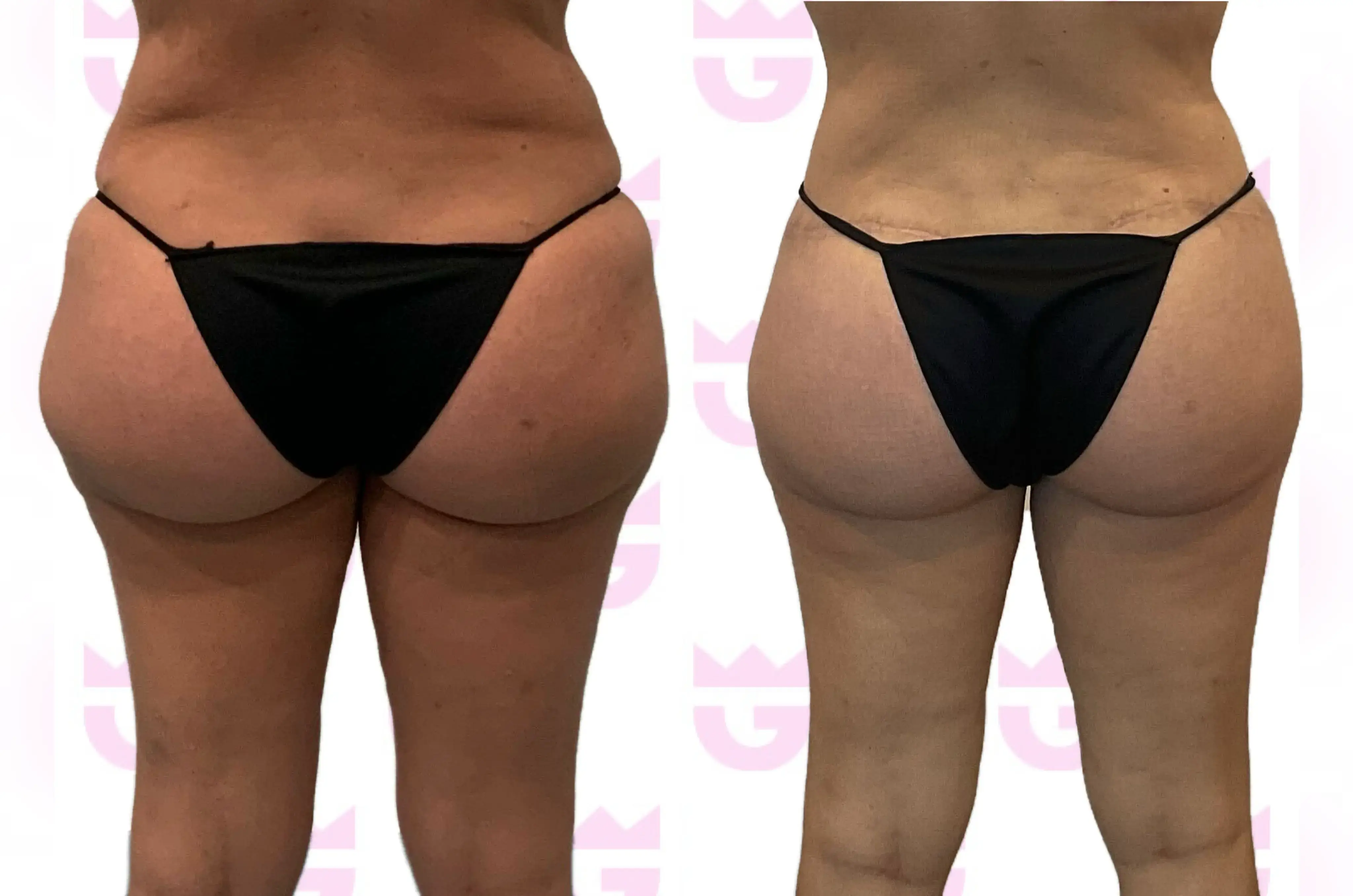 Thigh Lift Gallery