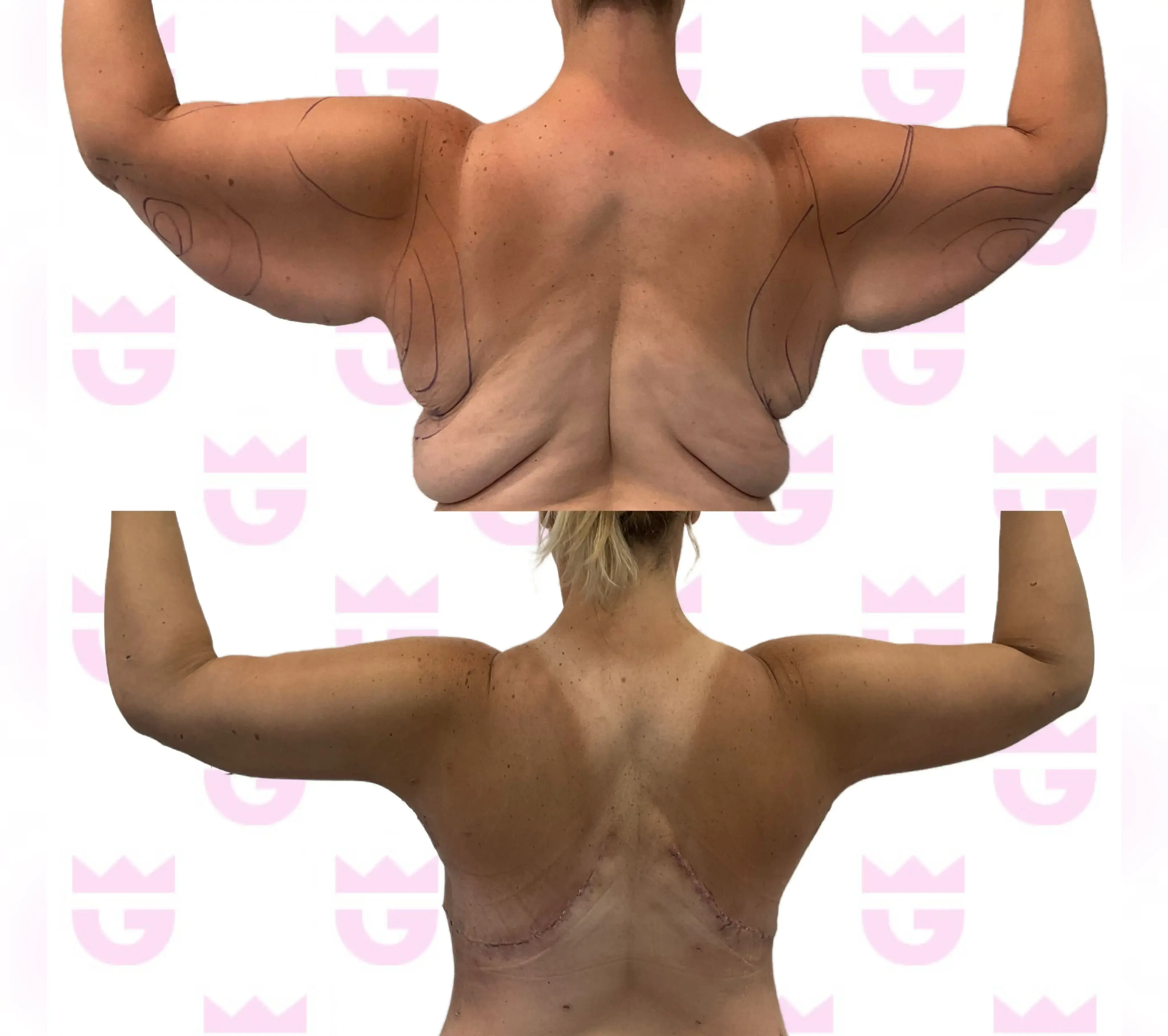 Back Liposuction Gallery