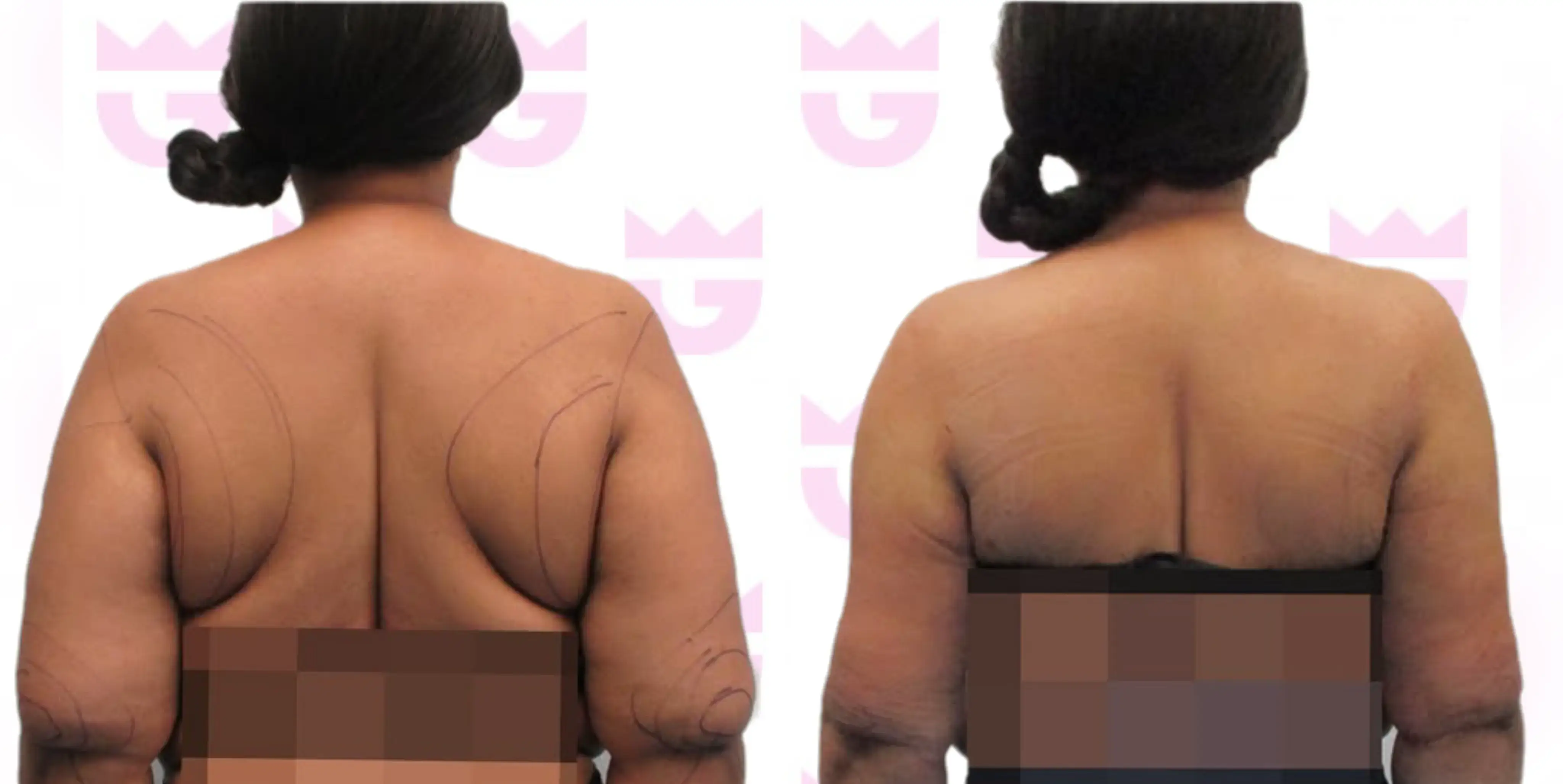 Back Liposuction Gallery