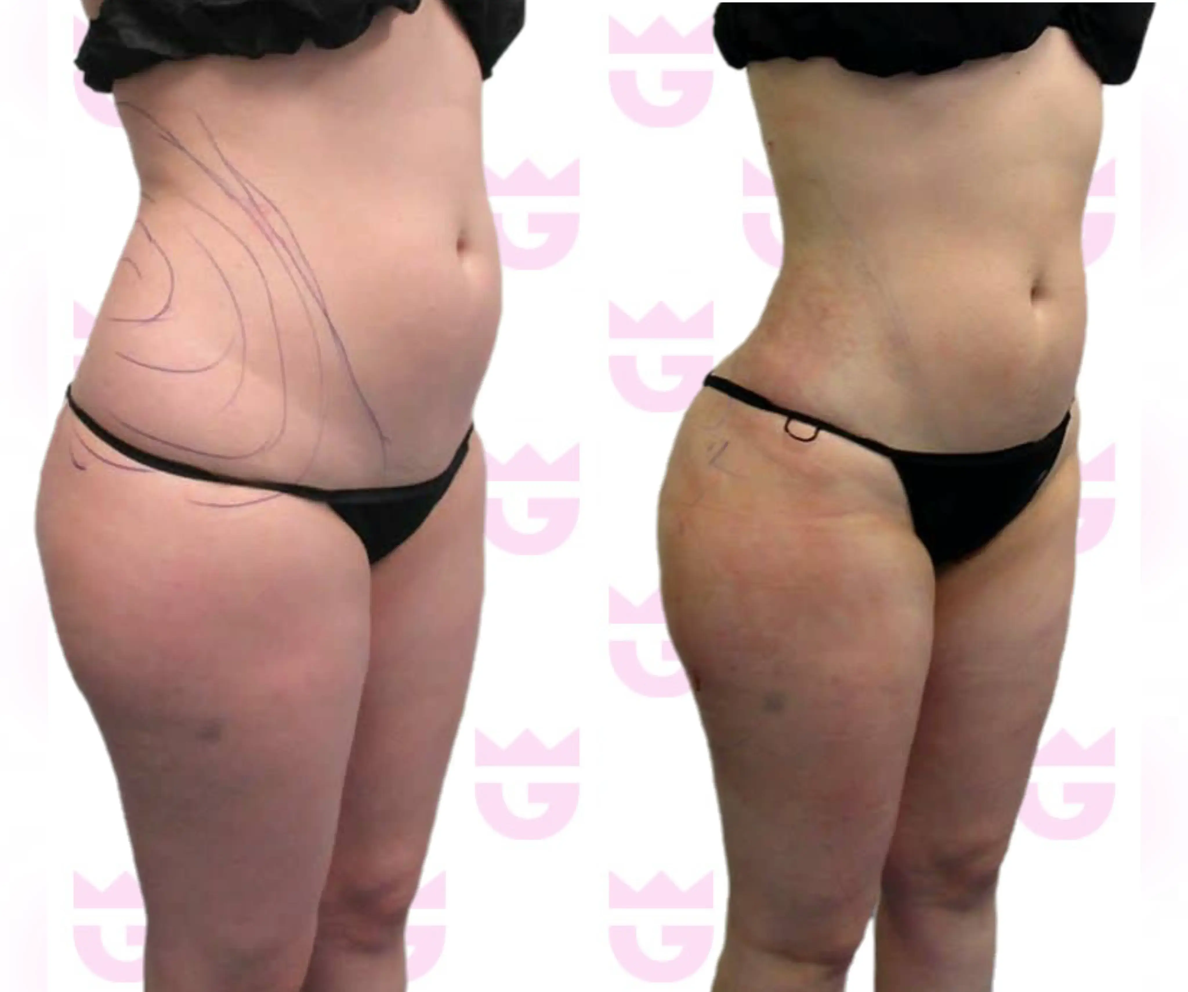 Abdomen Liposuction Gallery