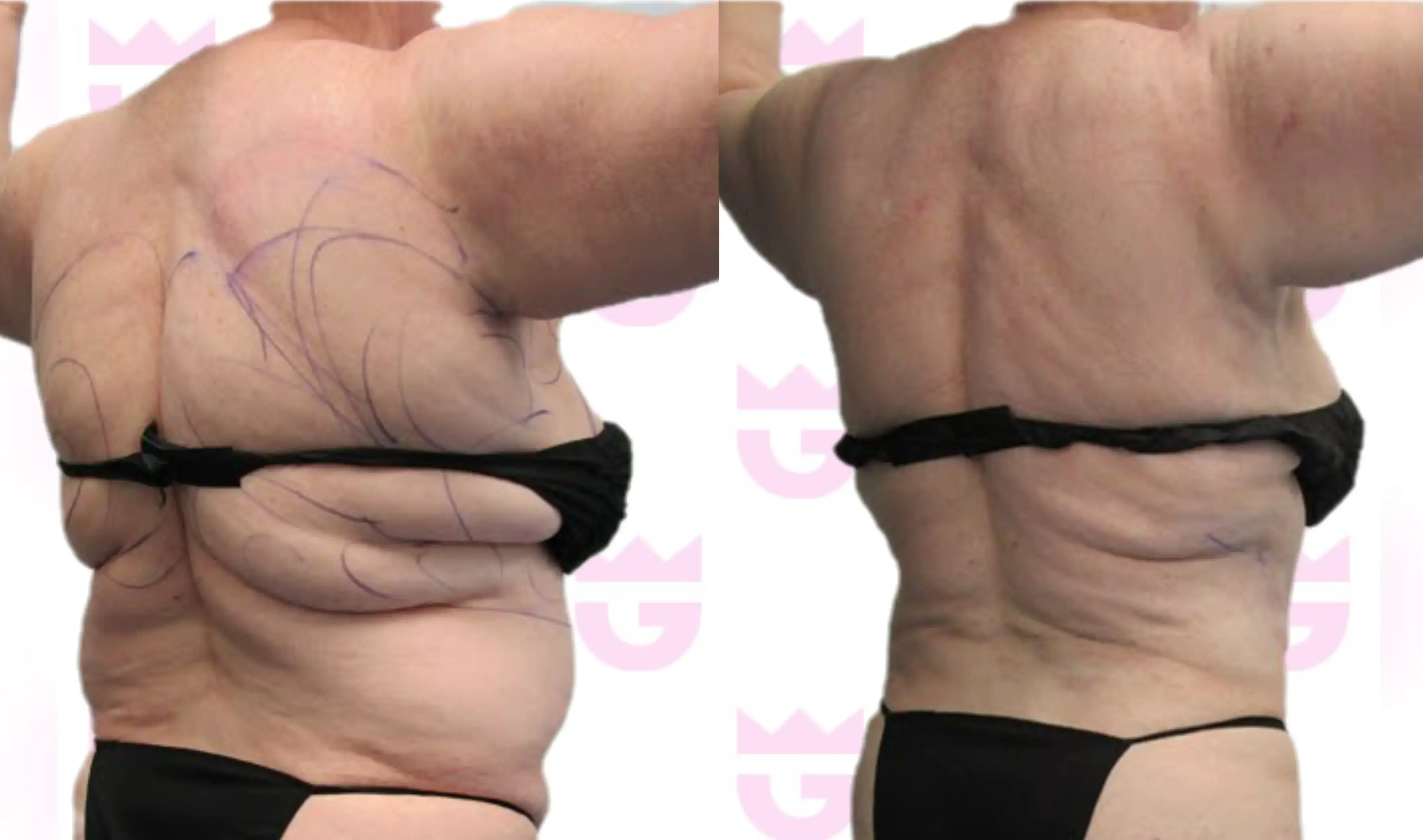Back Liposuction Gallery