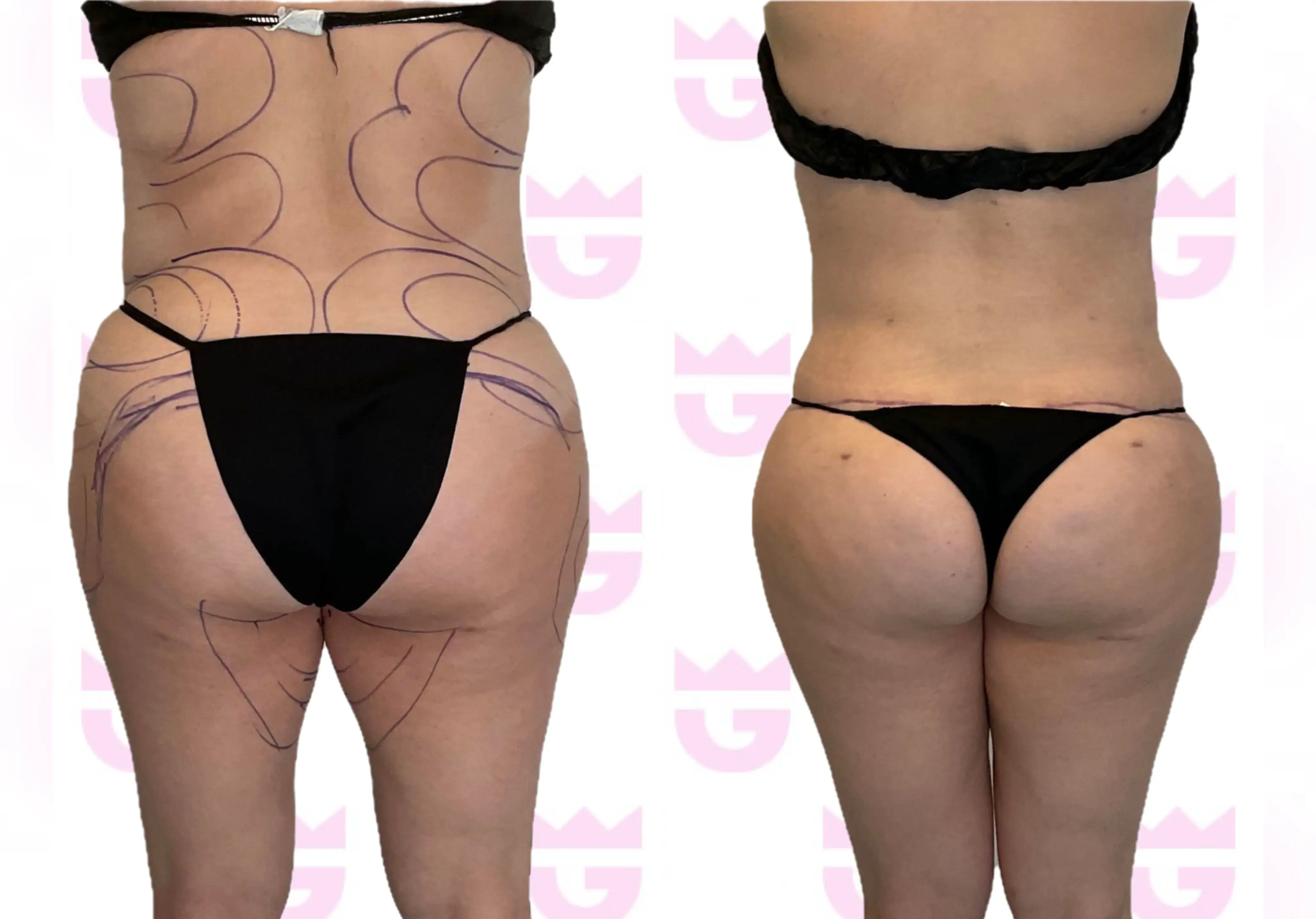 Buttock Lift Gallery