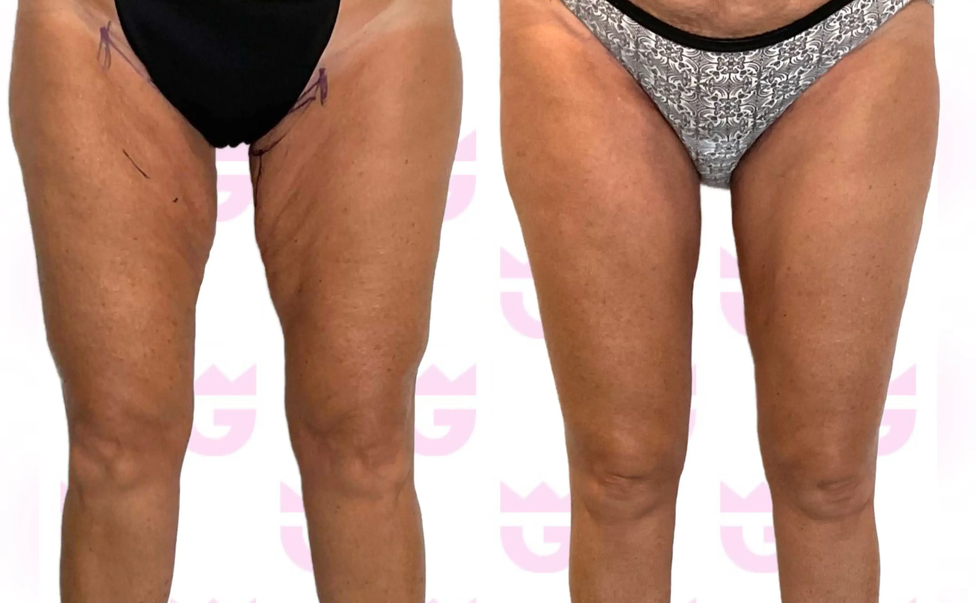 Thigh Lift Gallery