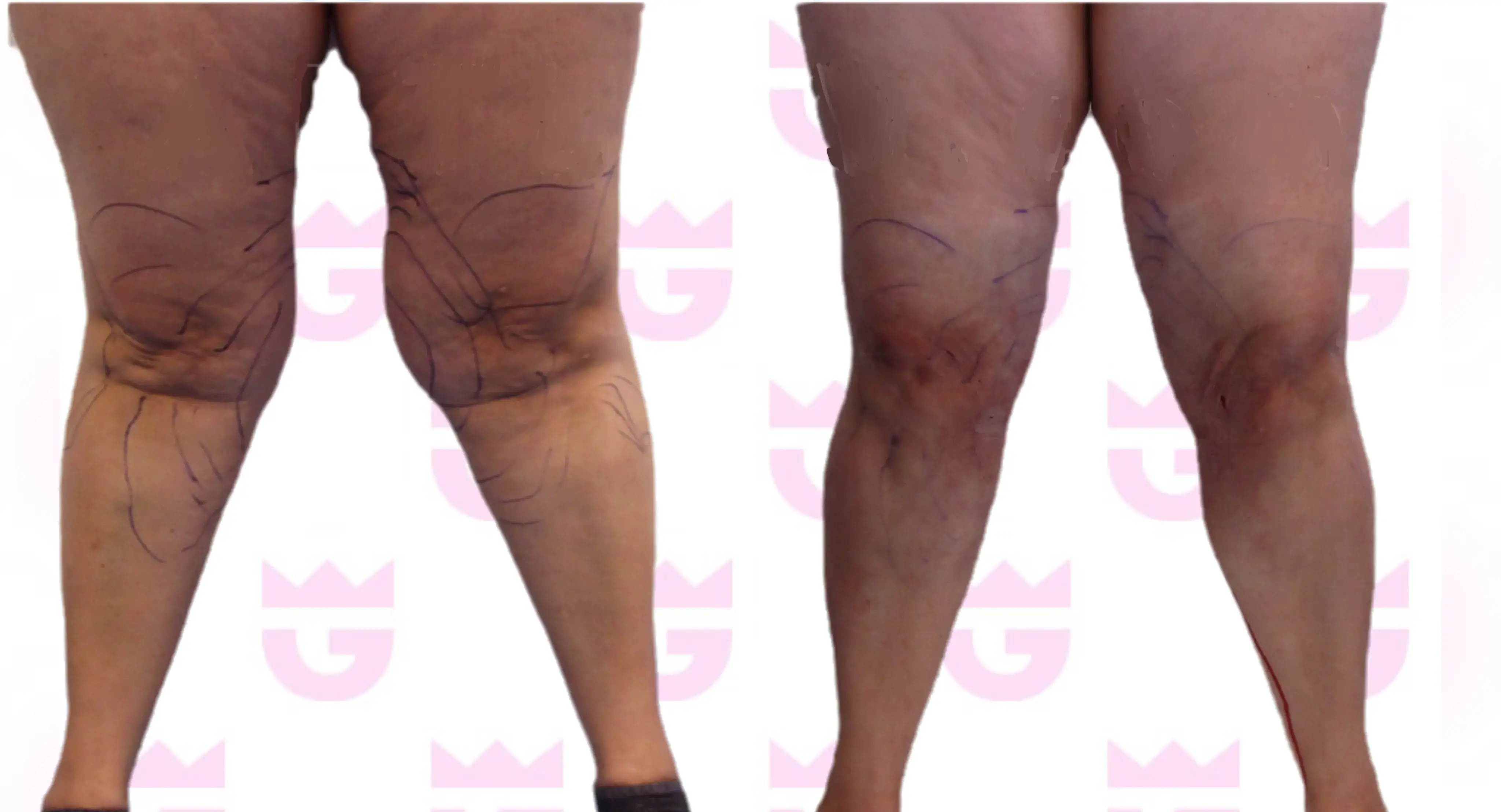 Knee Liposuction Gallery