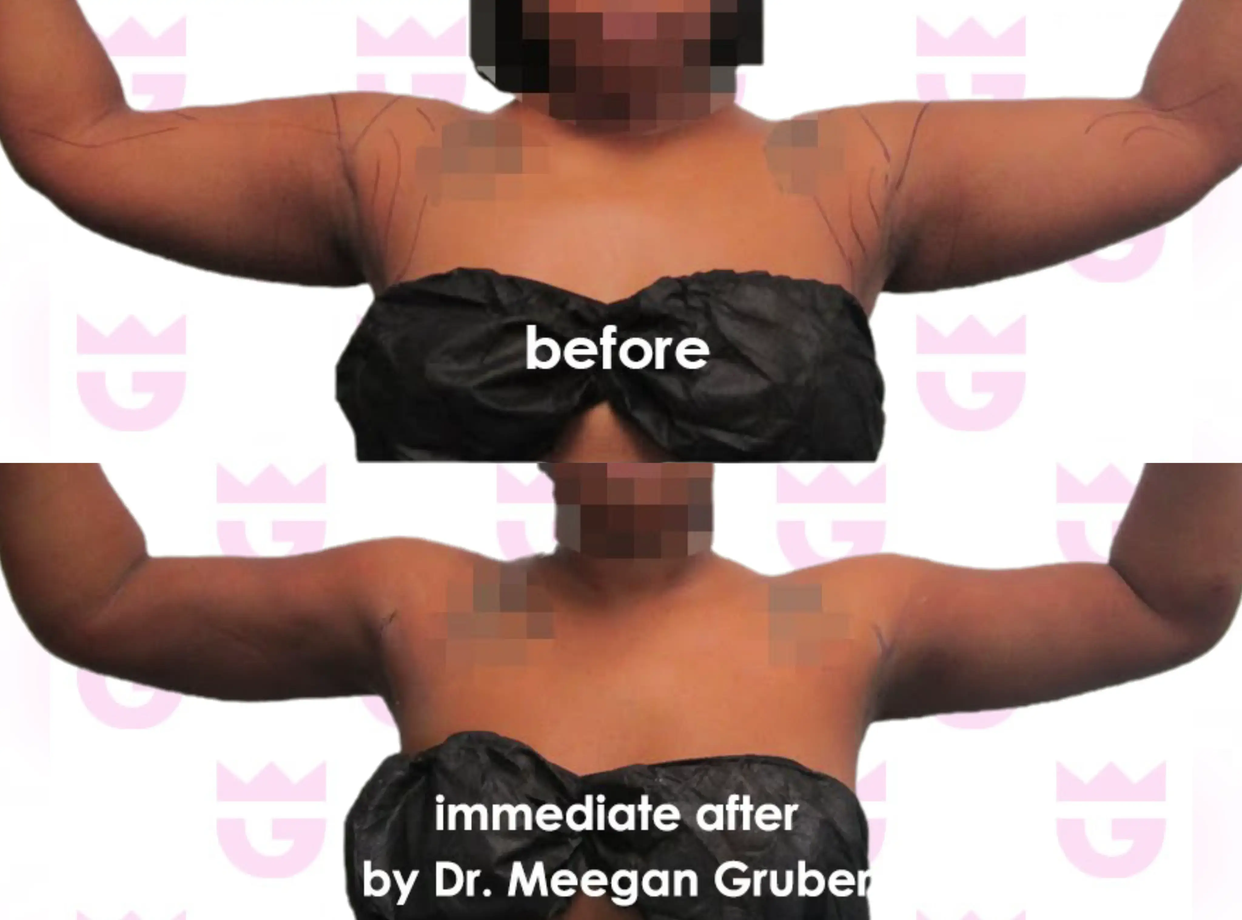 Armpit Liposuction Gallery