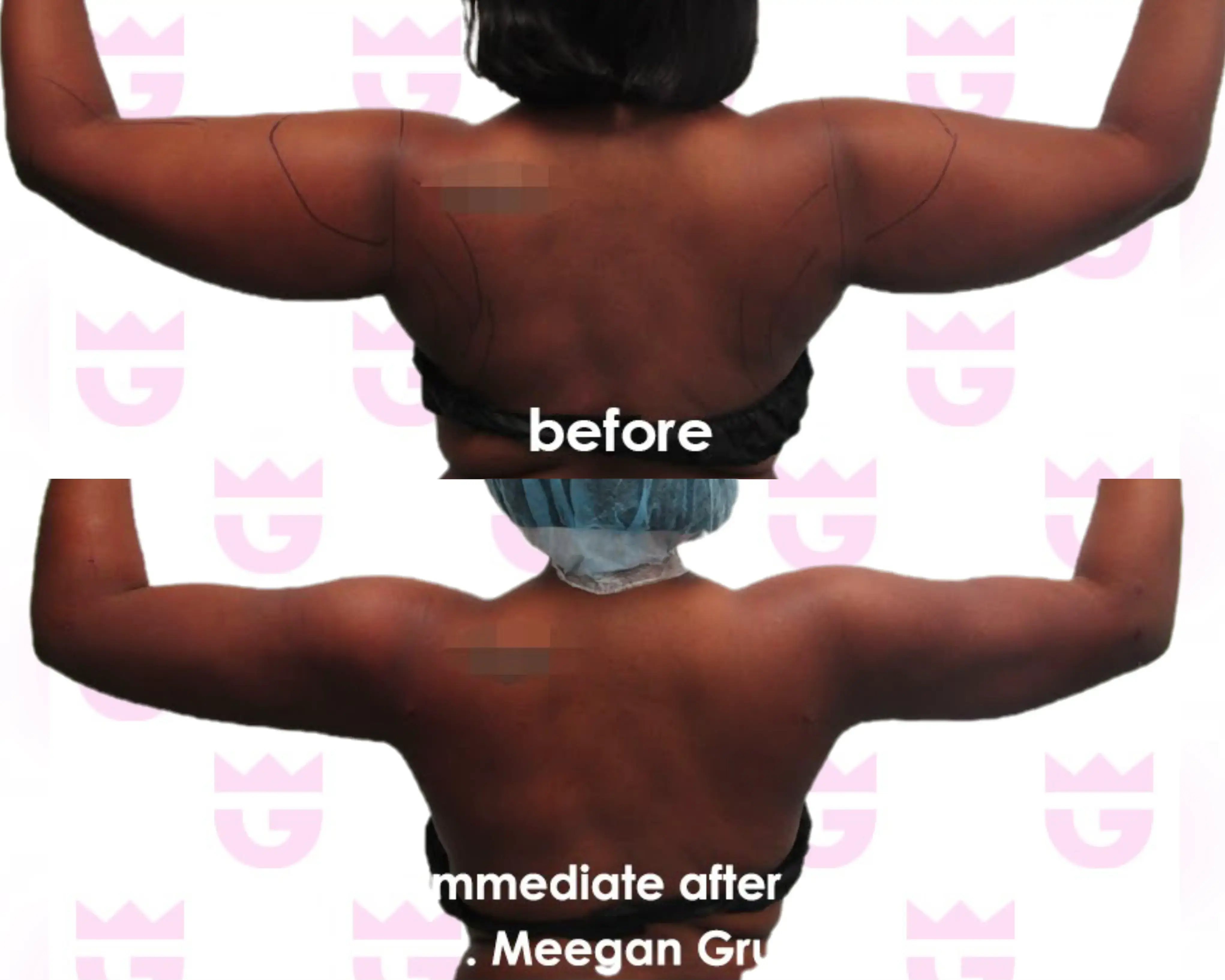 Armpit Liposuction Gallery