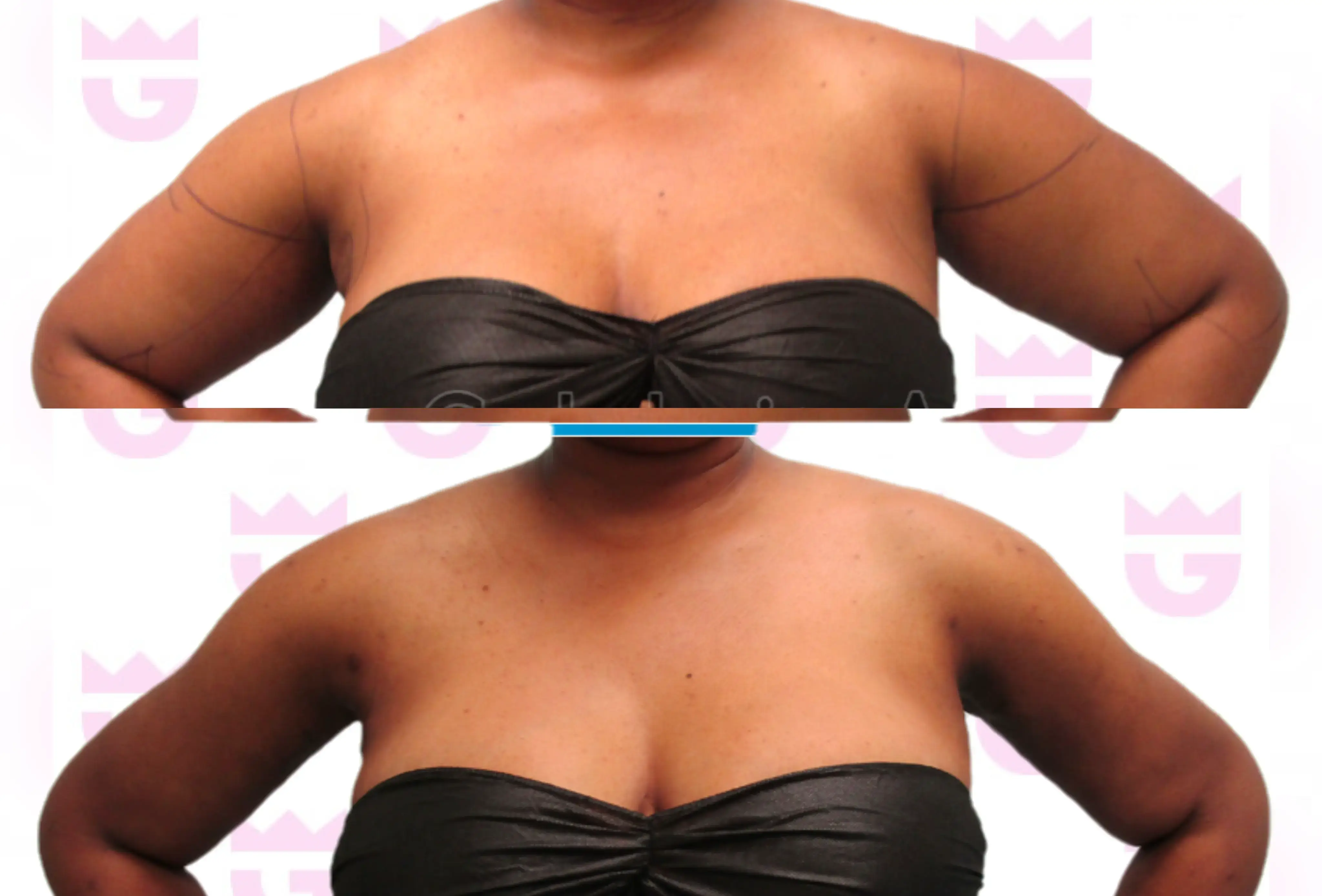 Arm Liposuction Gallery