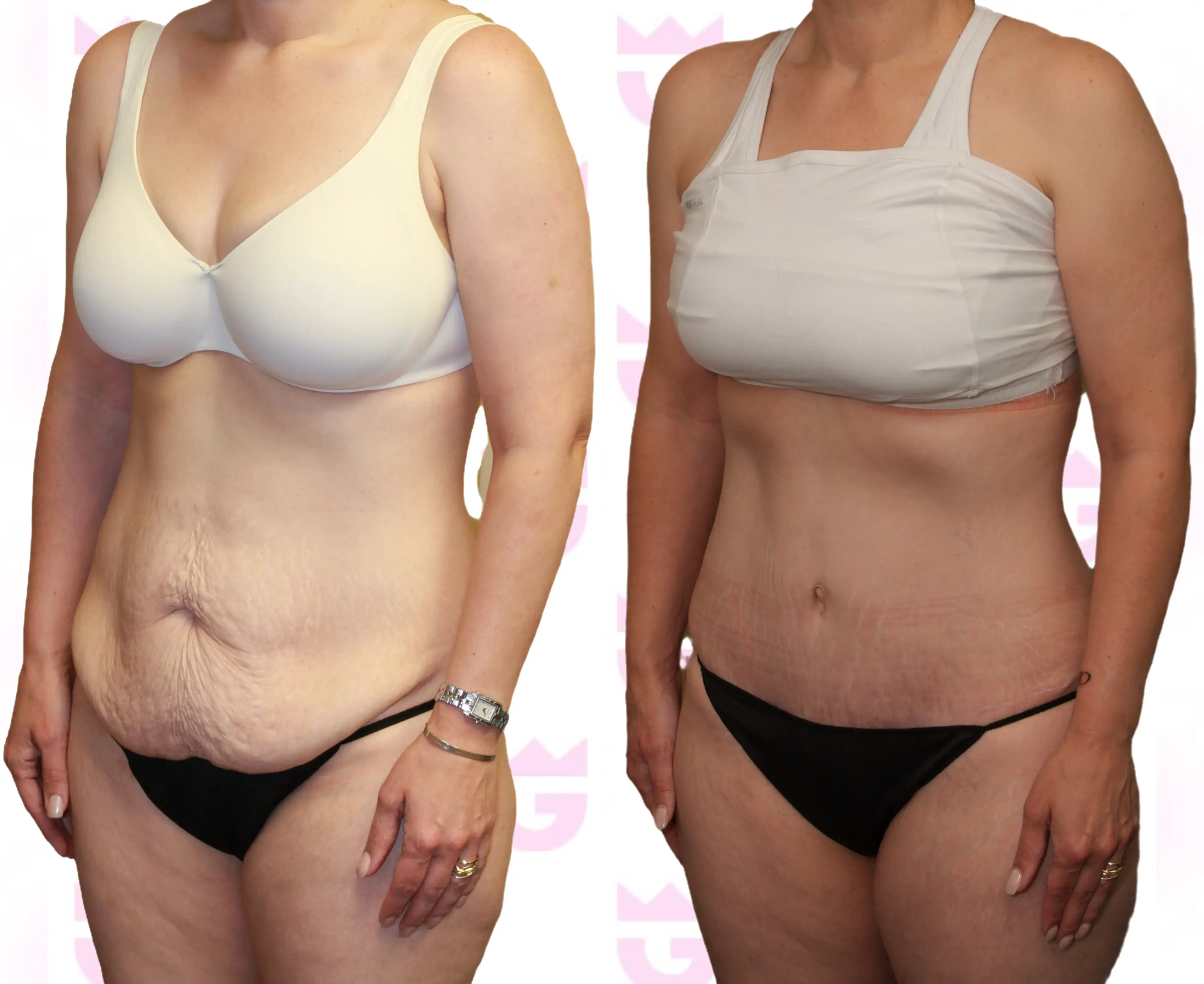 Tummy Tuck (Abdominoplasty) Gallery