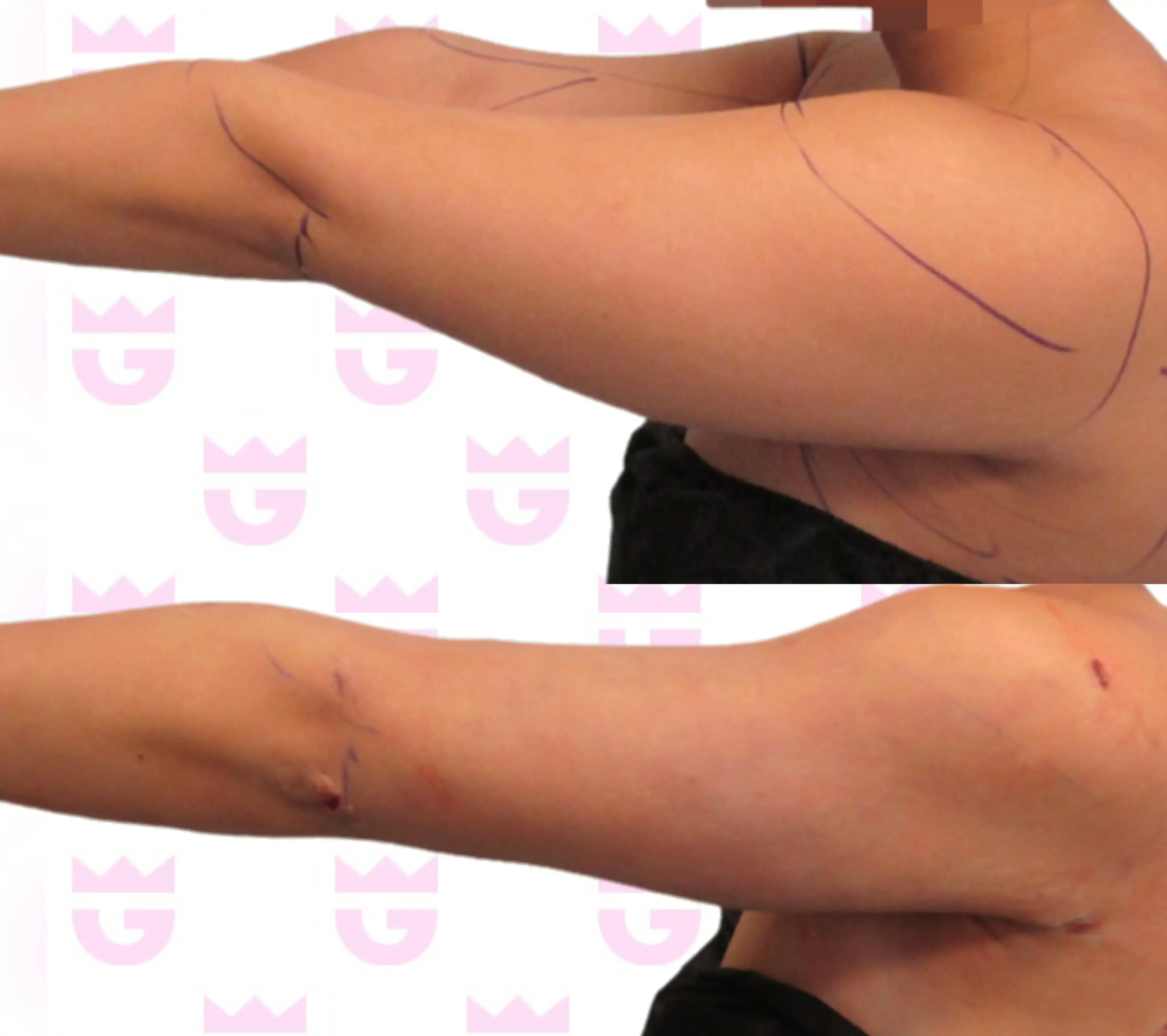 Arm Liposuction Gallery