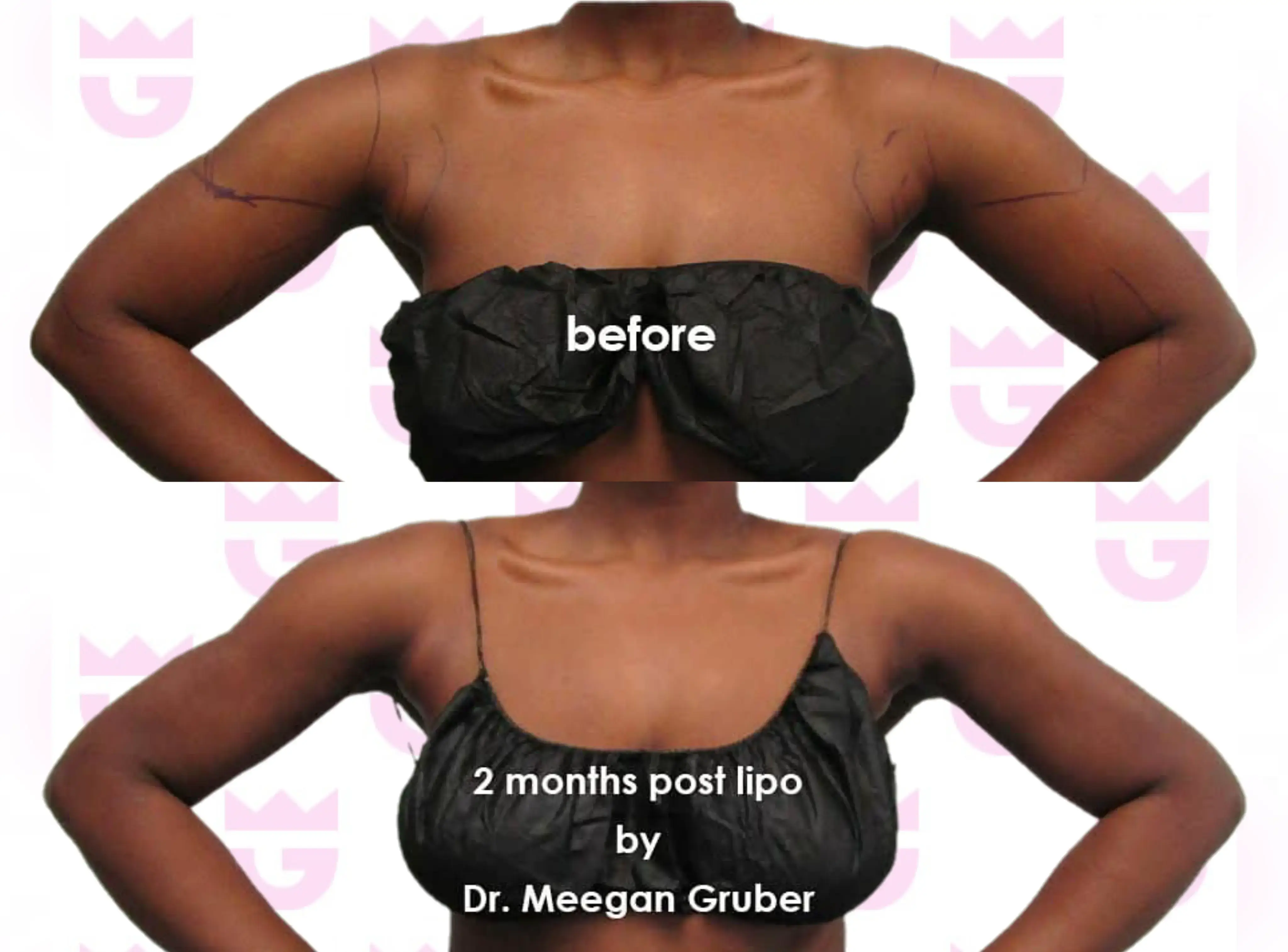 Arm Liposuction Gallery