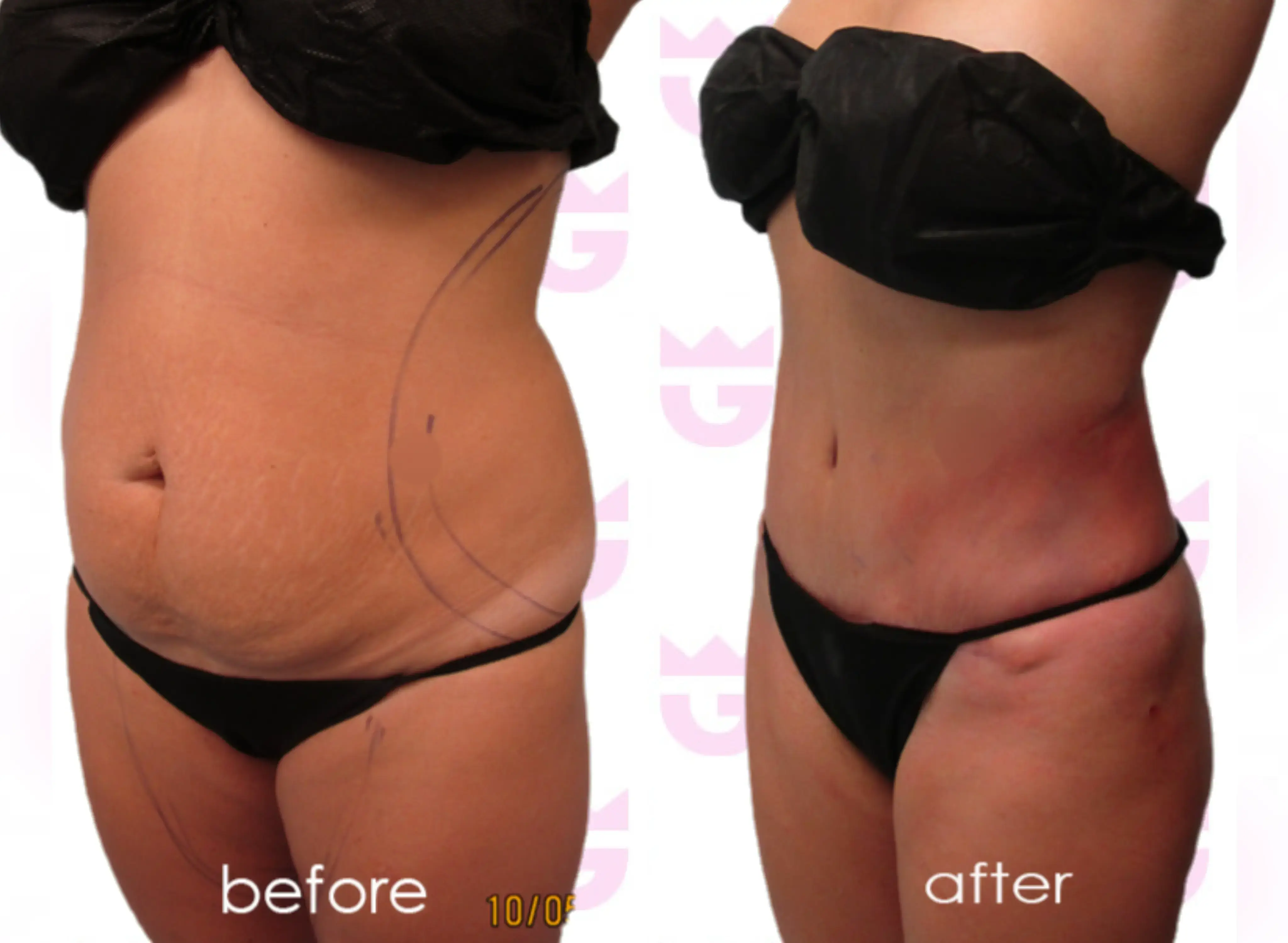 Tummy Tuck (Abdominoplasty) Gallery
