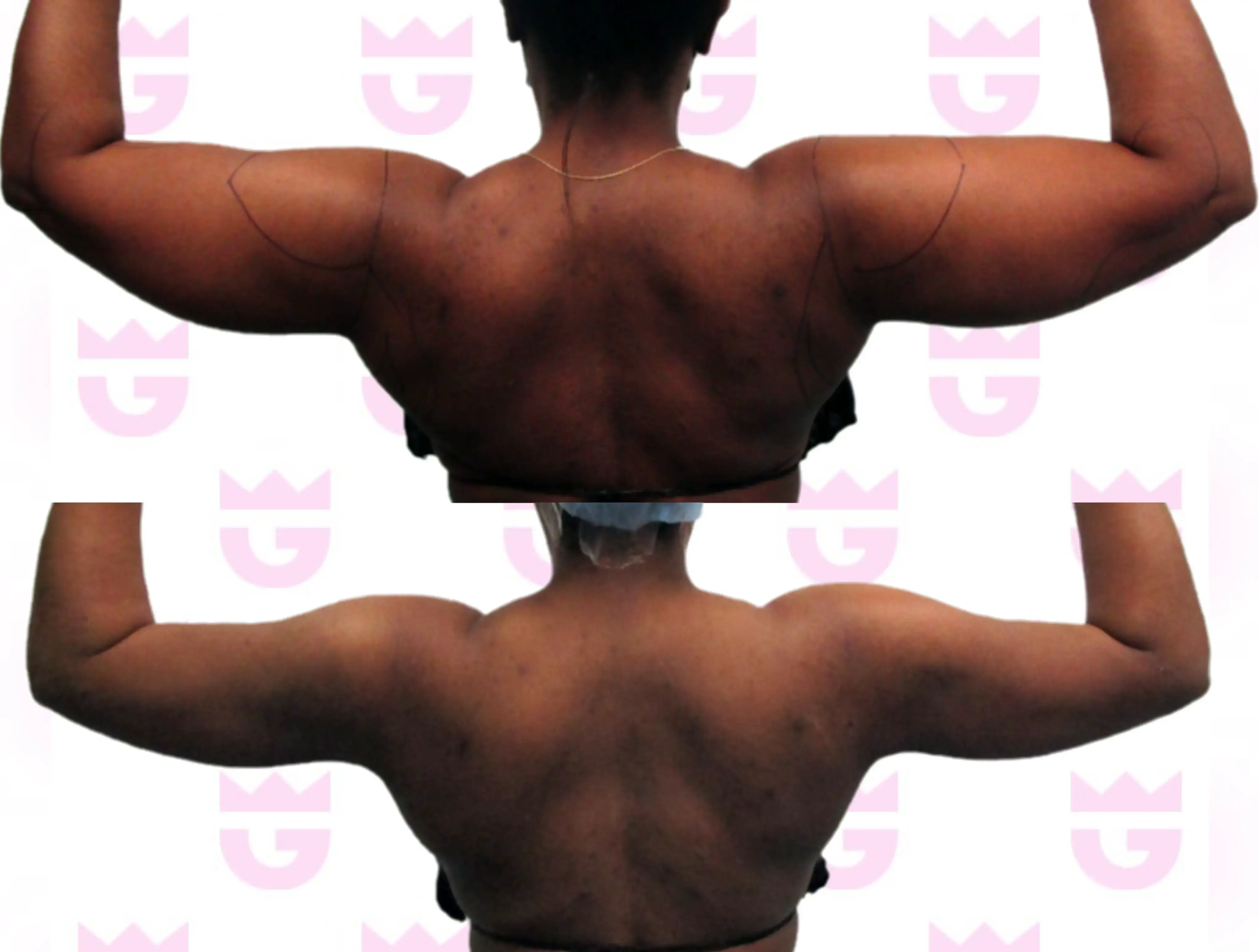 Armpit Liposuction Gallery