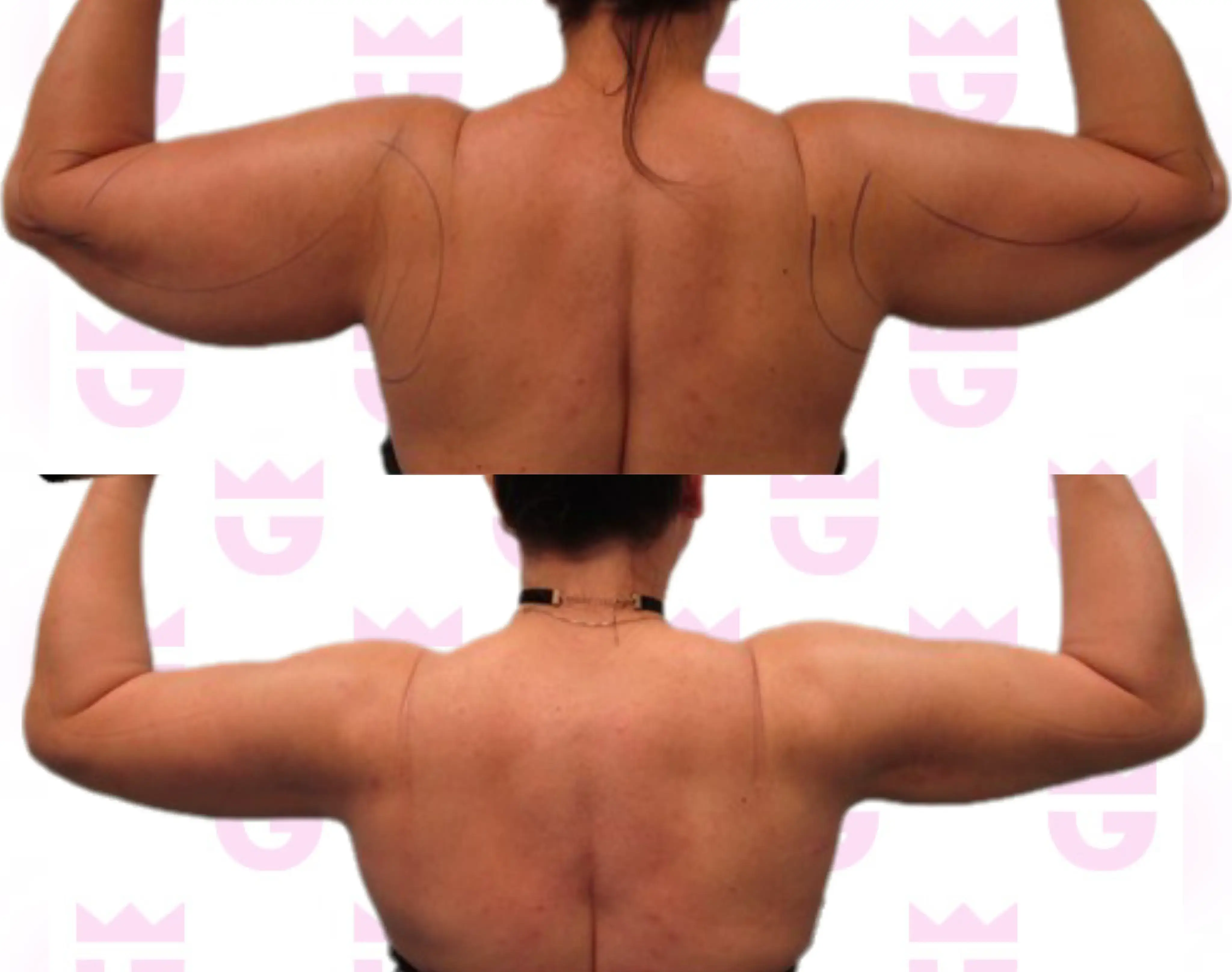 Armpit Liposuction Gallery